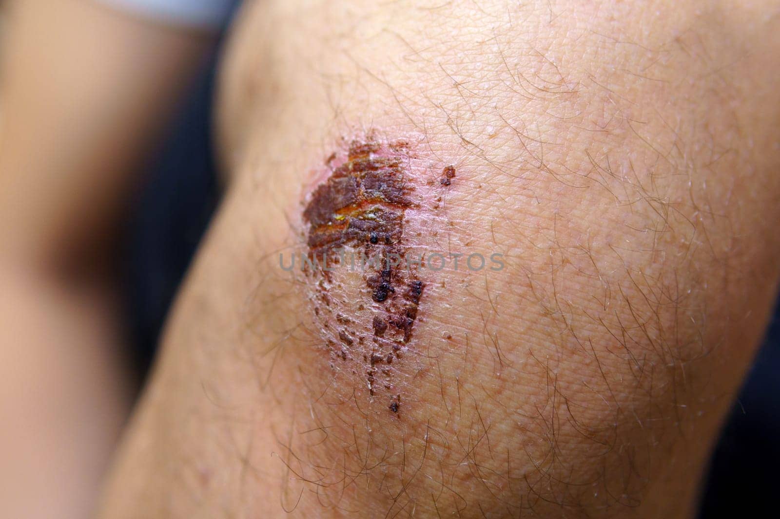 Close-Up View of a Wound on a Person Leg, selective focus