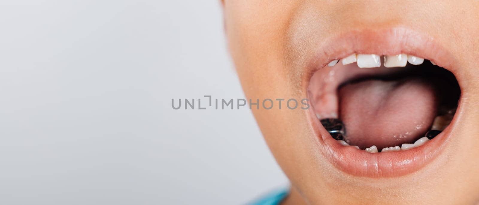 A dental image of a stainless steel crown a silver cap used to restore teeth damaged by decay or fractures in kids. Dental health concept. Steel crown silver caps for kid problem teeth.