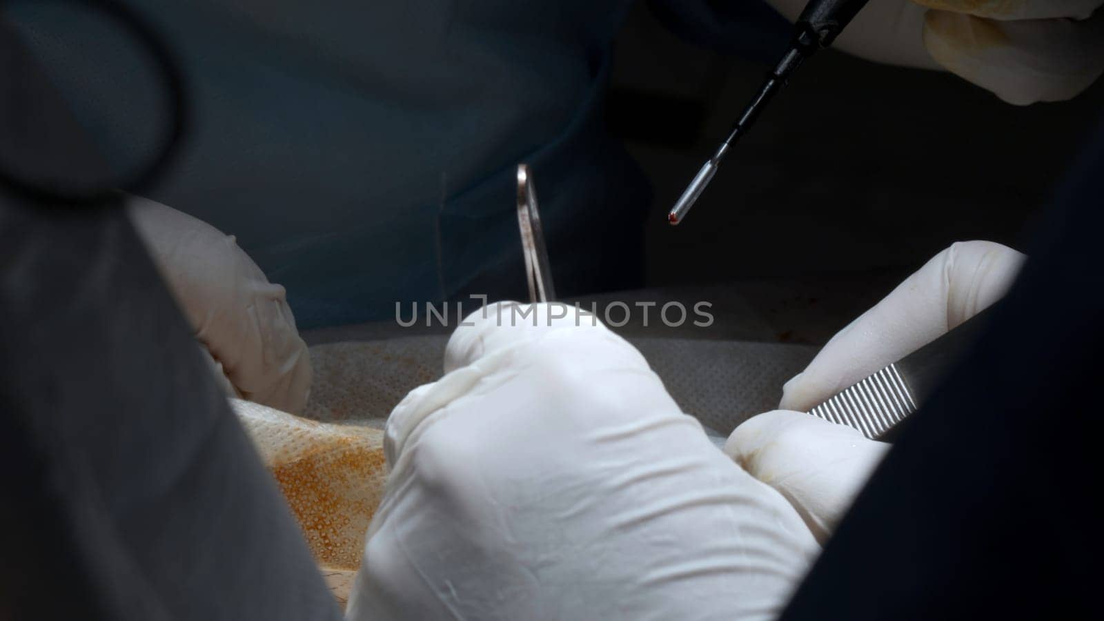 Close up of process of the real surgery at the hospital. Action. Medical tools and equipment