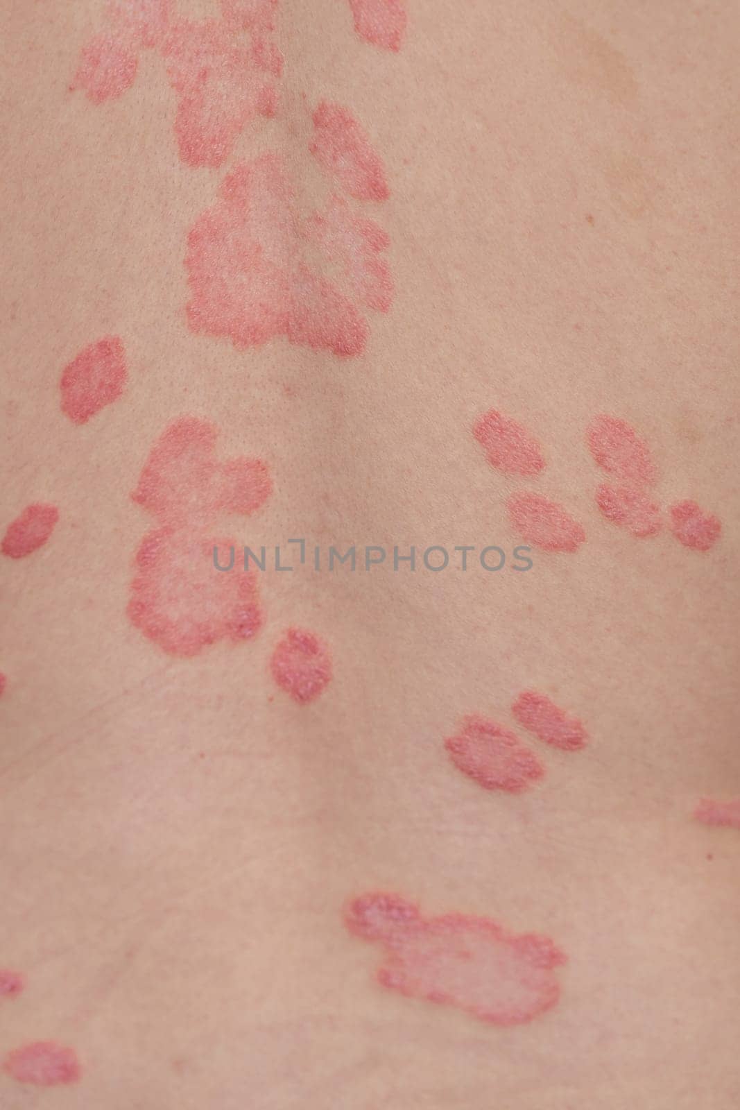 Psoriasis Vulgaris, skin patches are typically red, itchy, and scaly. Papules of chronic psoriasis vulgaris on male hand, back and body. Genetic immune disease. Detail of psoriatic skin disease