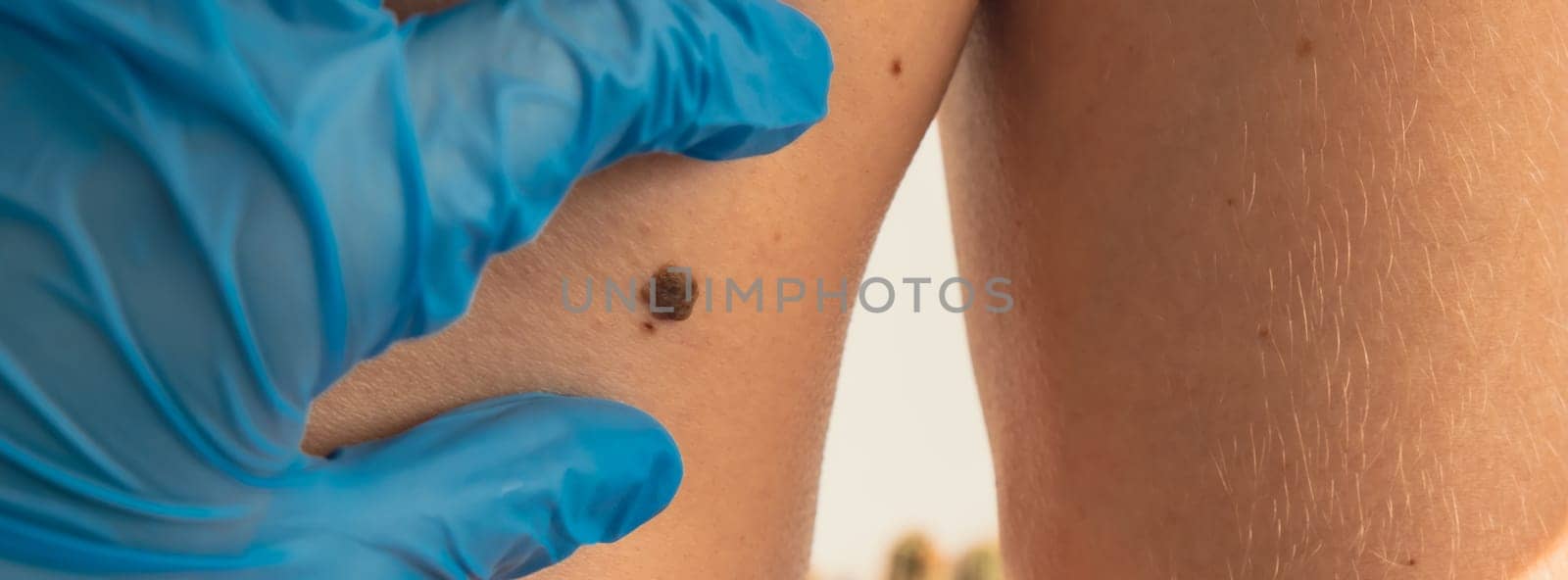 Doctor in medical gloves examining man skin mole. Dermatologist checking male birthmarks. Self care preventing cancer procedure. Protection treatment. Imperfection skin positivity