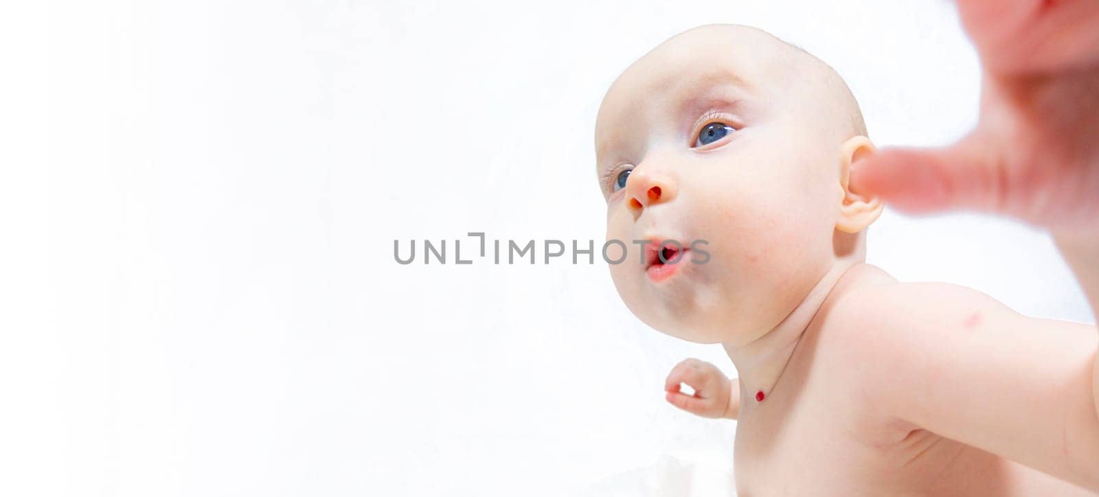 a baby with a hemangioma on his neck lies on a white background. banner with a copy space. profile of a little bald baby girl. the kid looks to the side