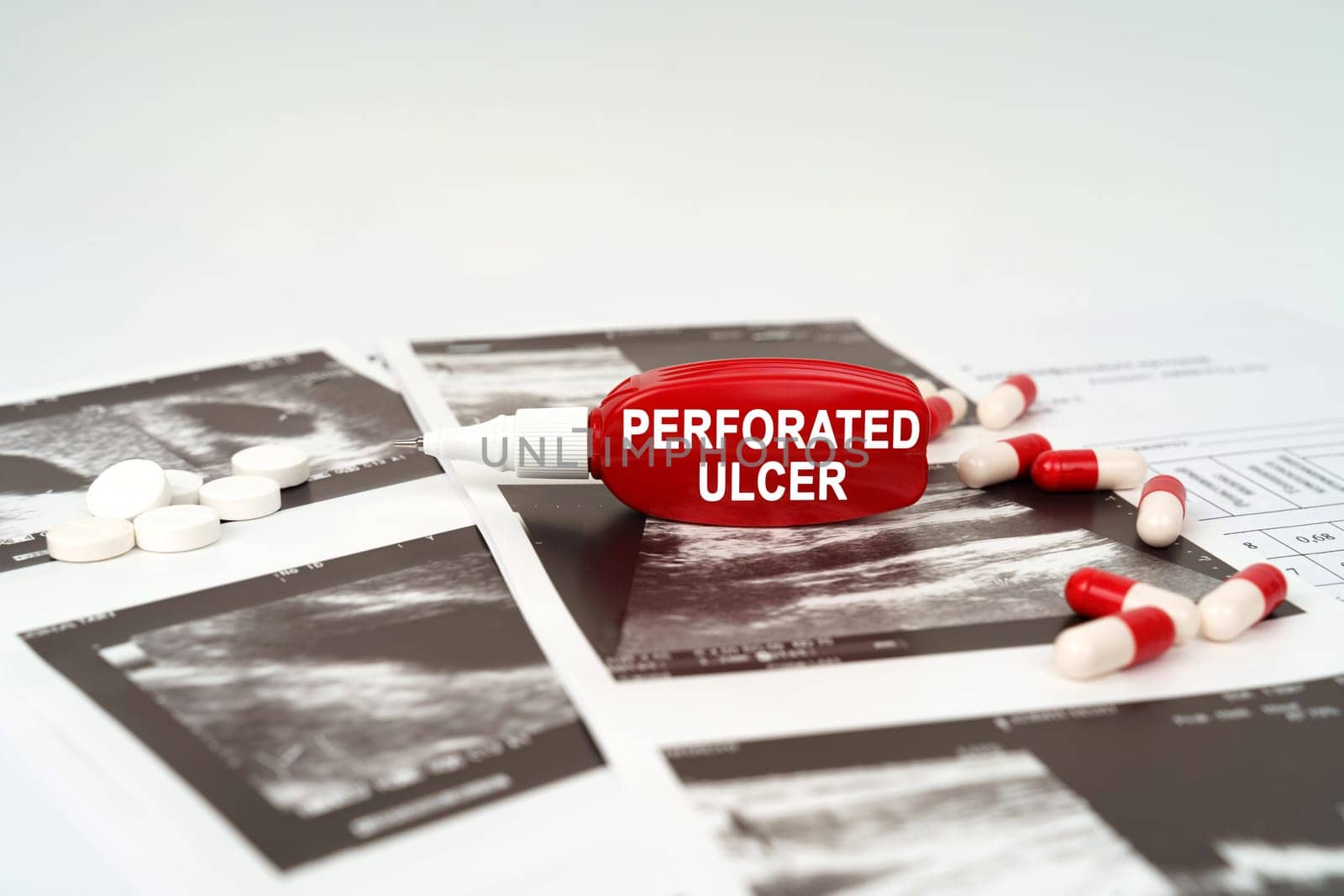 Medical concept. On the ultrasound pictures there are pills and a pen with the inscription - Perforated ulcer