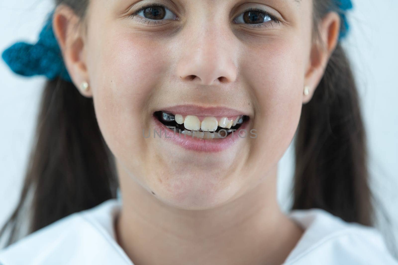 a little girl with a shifted dentition demonstrates her teeth