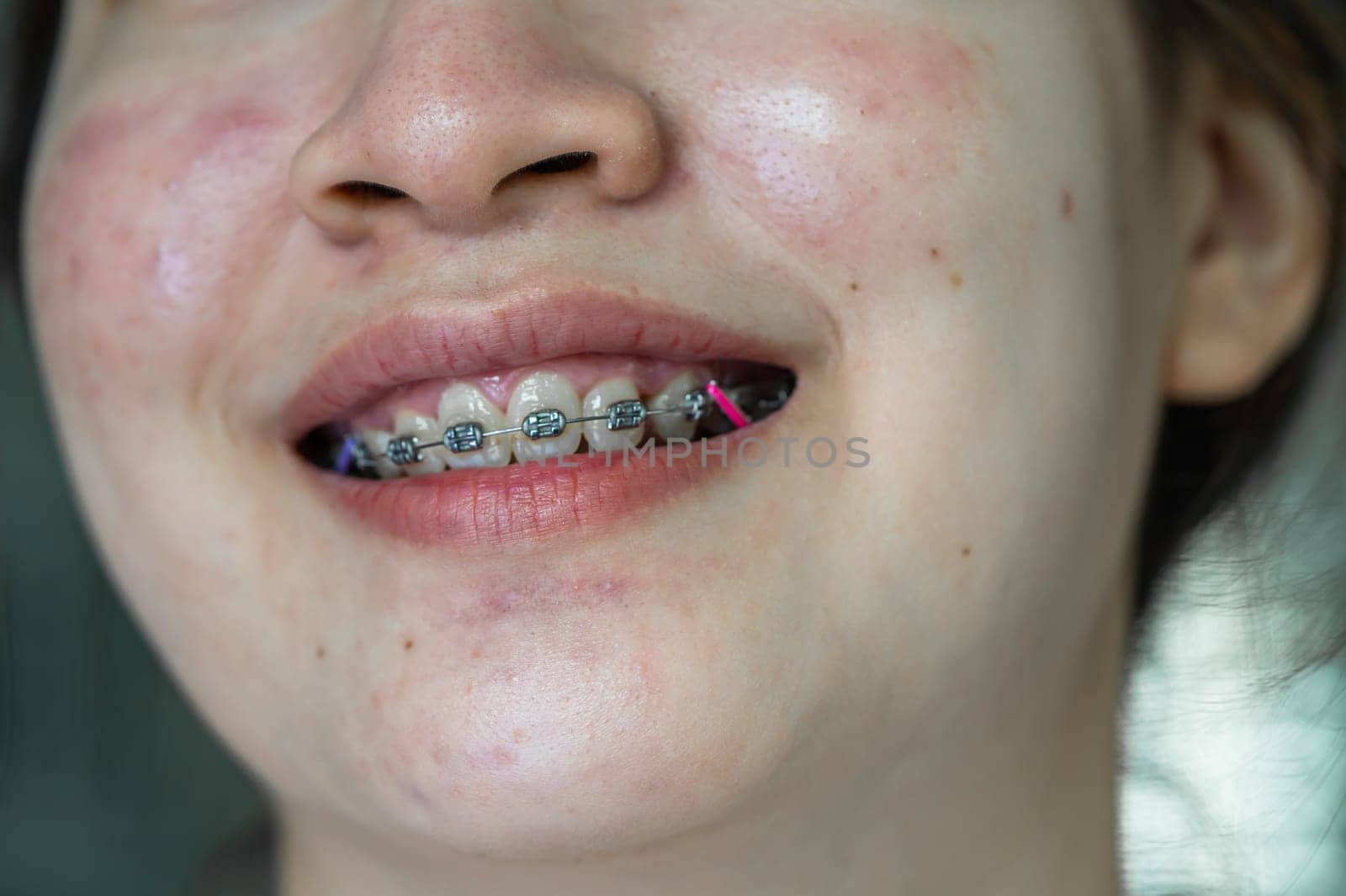 Braces in teenage girl mouth to treat and beauty for increase confidence and good personality.
