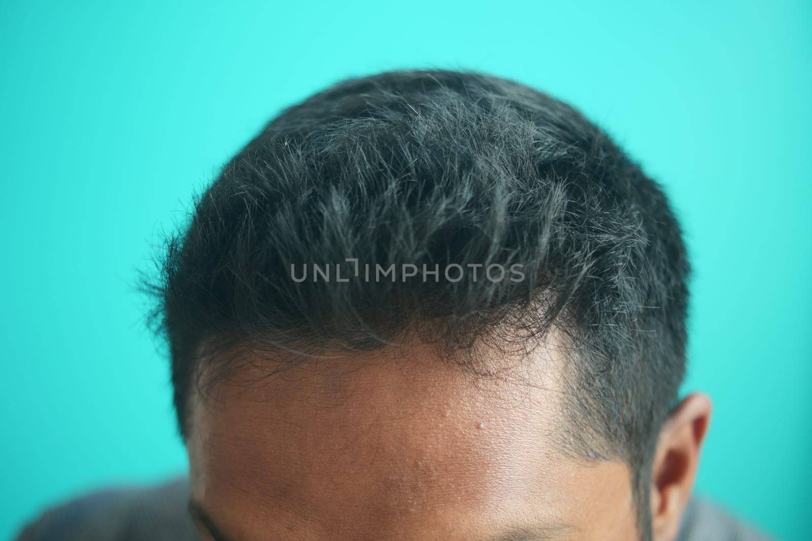 hair loss concept with man checking his hair by towfiq007
