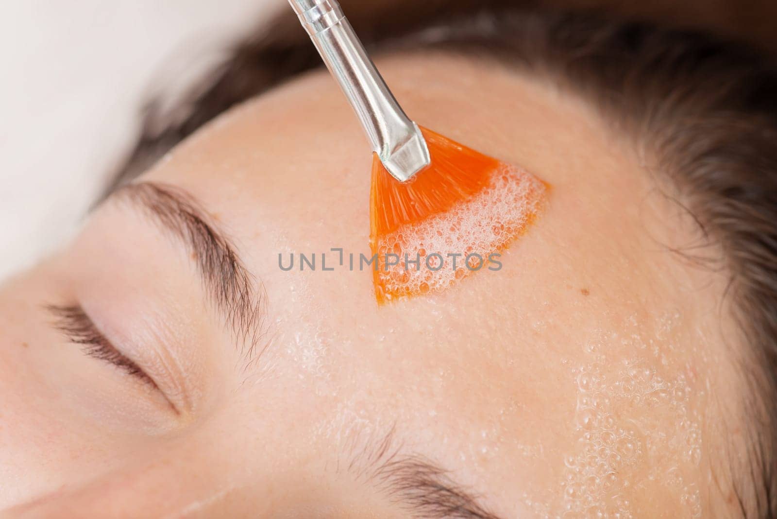 Applying special gel with brush for injection of carbon dioxide under the skin, carboxytherapy