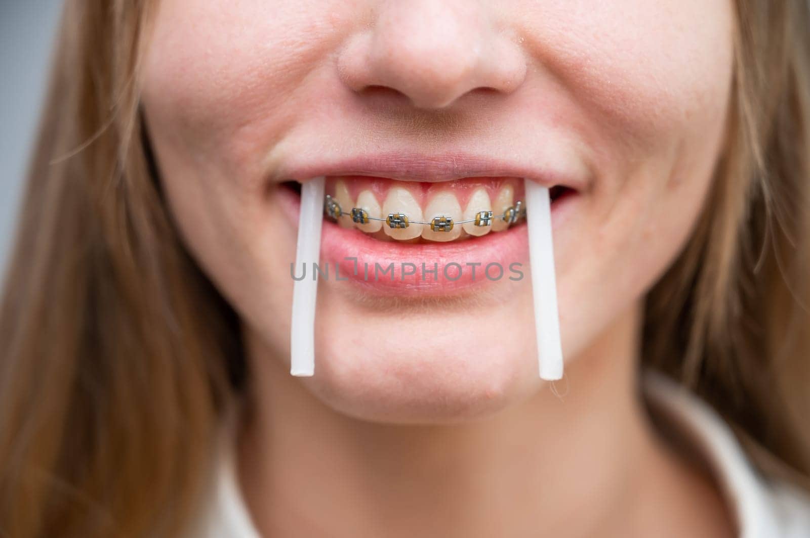 Close-up portrait of a woman with braces using special orthodontic wax. Girl fooling around pretending to be a walrus