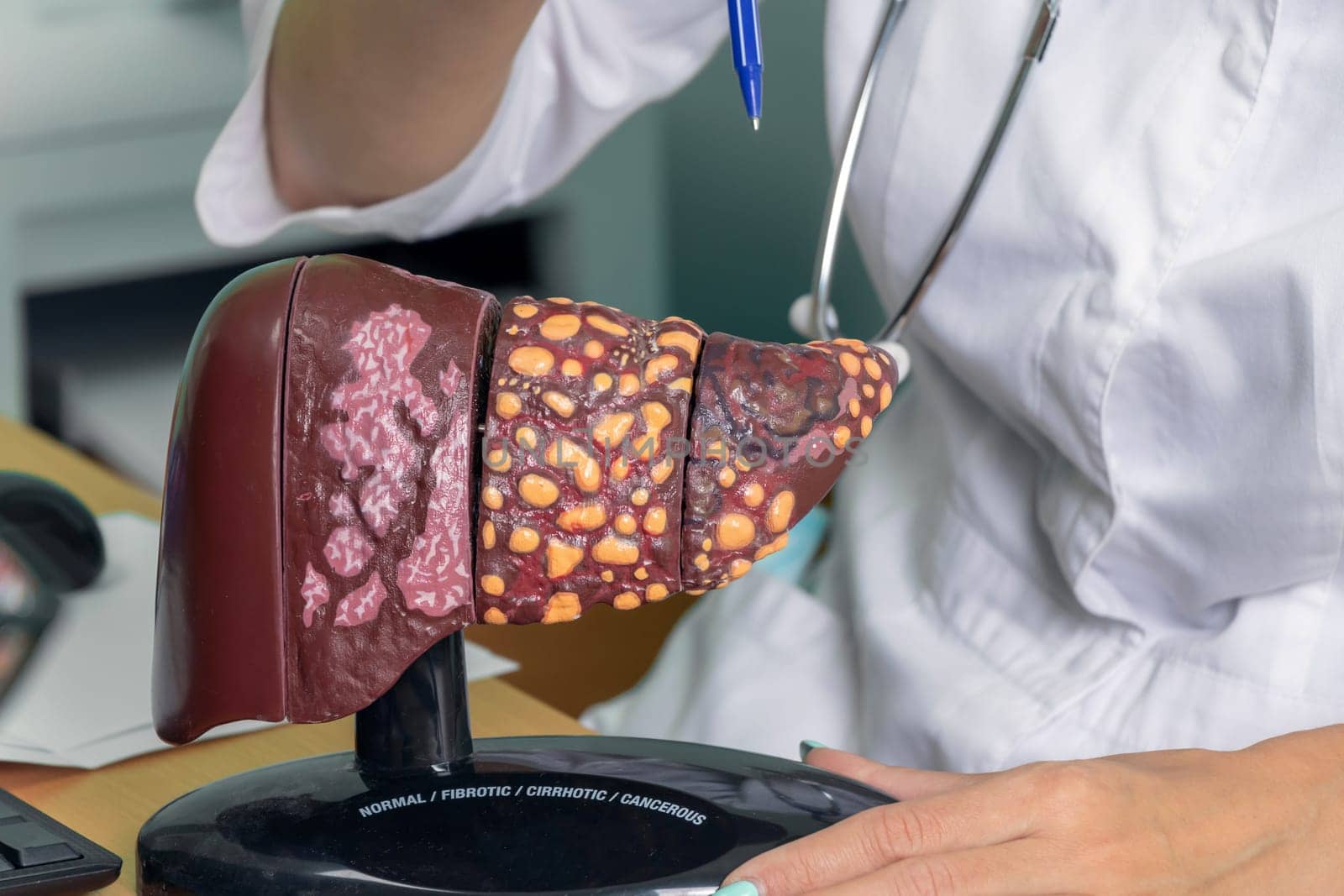 Close up of model of human liver with words normal, fibrotic, cirrhotic, cancerous. female doctor shows the patient a stage 4 liver: normal, fibrous, cirrhotic, malignant. The liver means your health and your life. by Leoschka