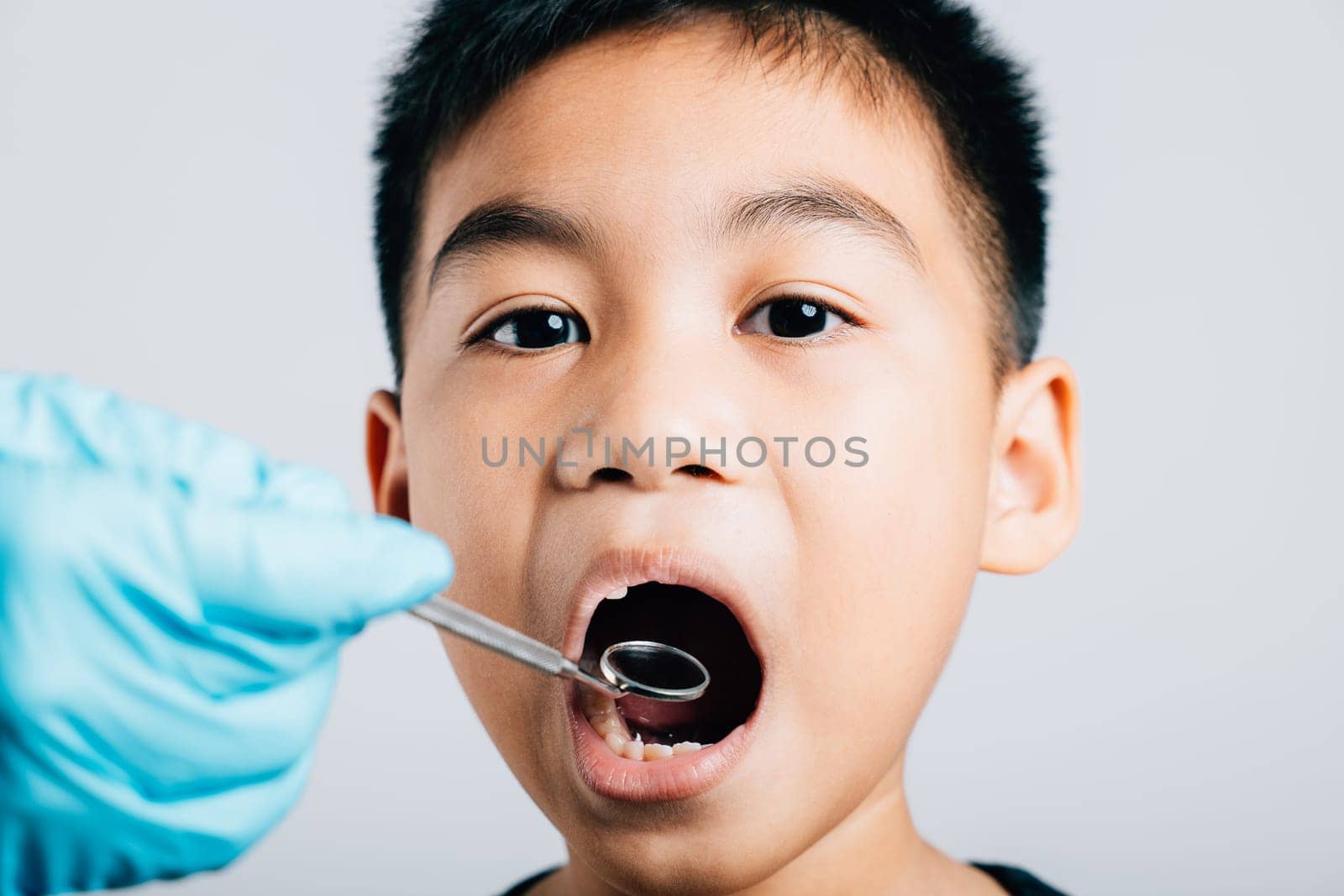 In a dental office a pediatric dentist examines a child's mouth after extraction of a loose milk tooth. Dental instruments aid in examination process. Doctor uses mouth mirror to checking teeth cavity by Sorapop