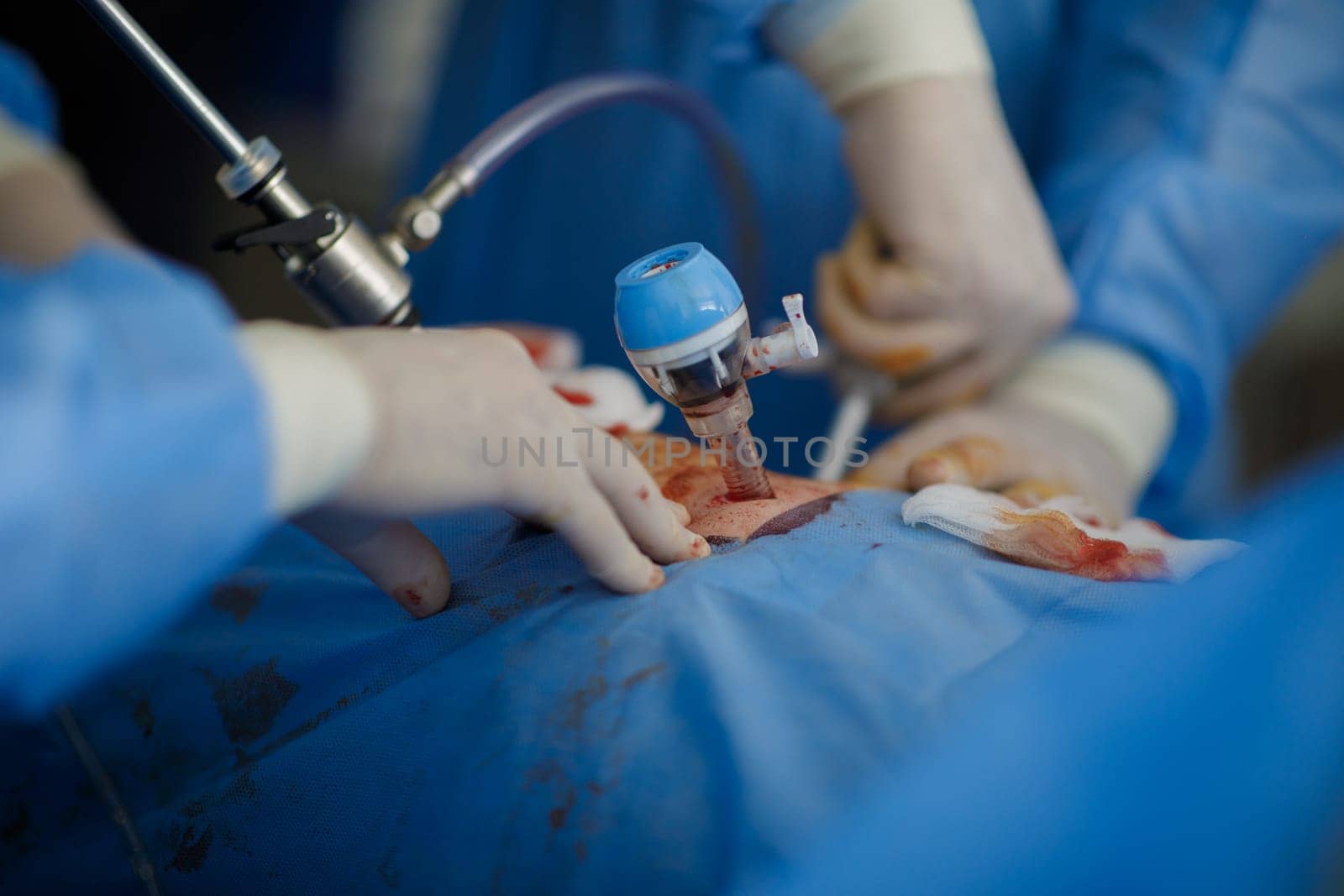 hands of doctors performing laparoscopy operations. High quality photo