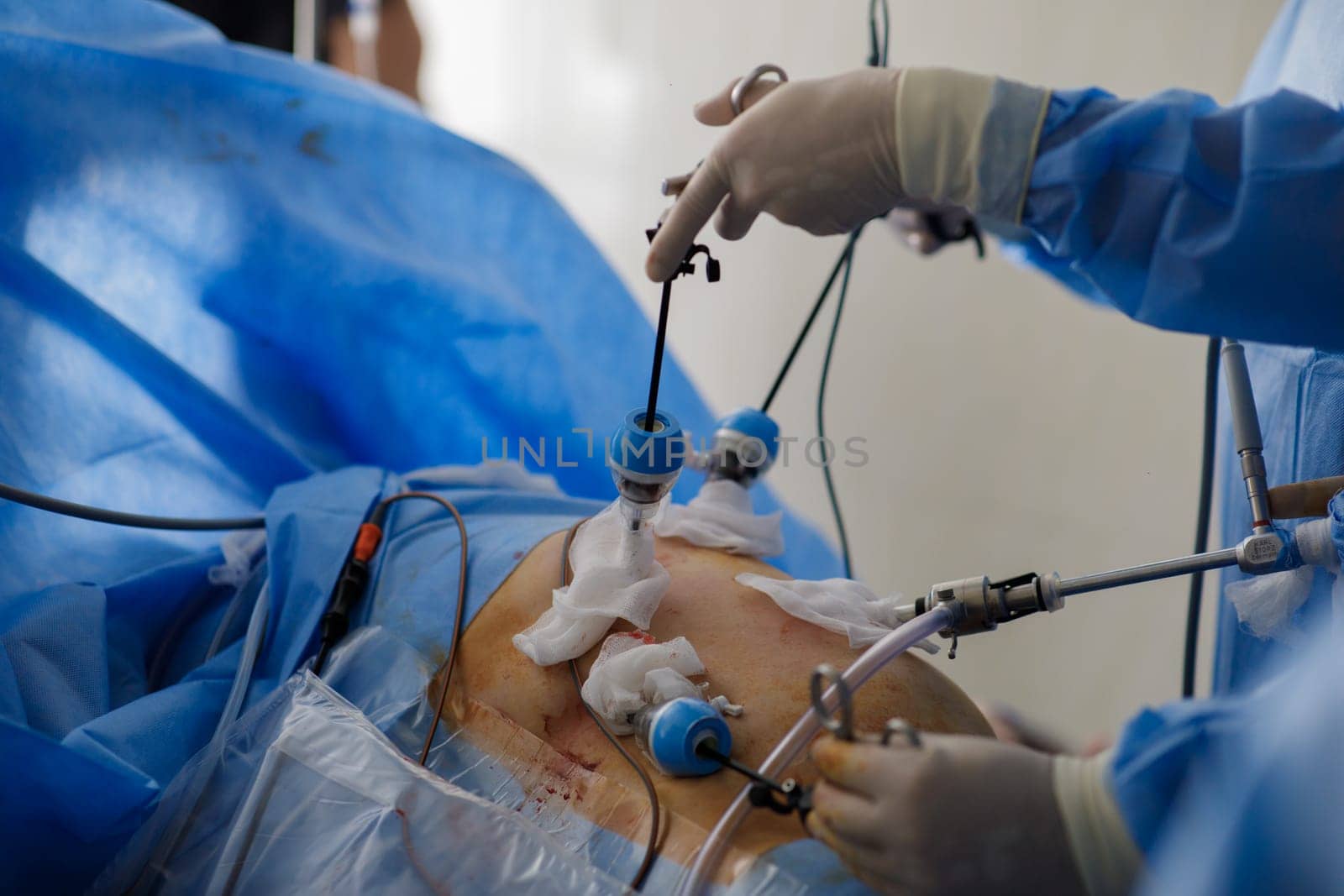 doctors perform laparoscopy operations in the intensive care unit. High quality photo