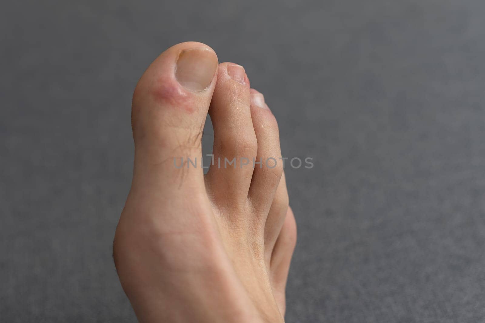 close-up of a man's toes with fungal disease, skin cracking and callus formation on his toes. by Andelov13