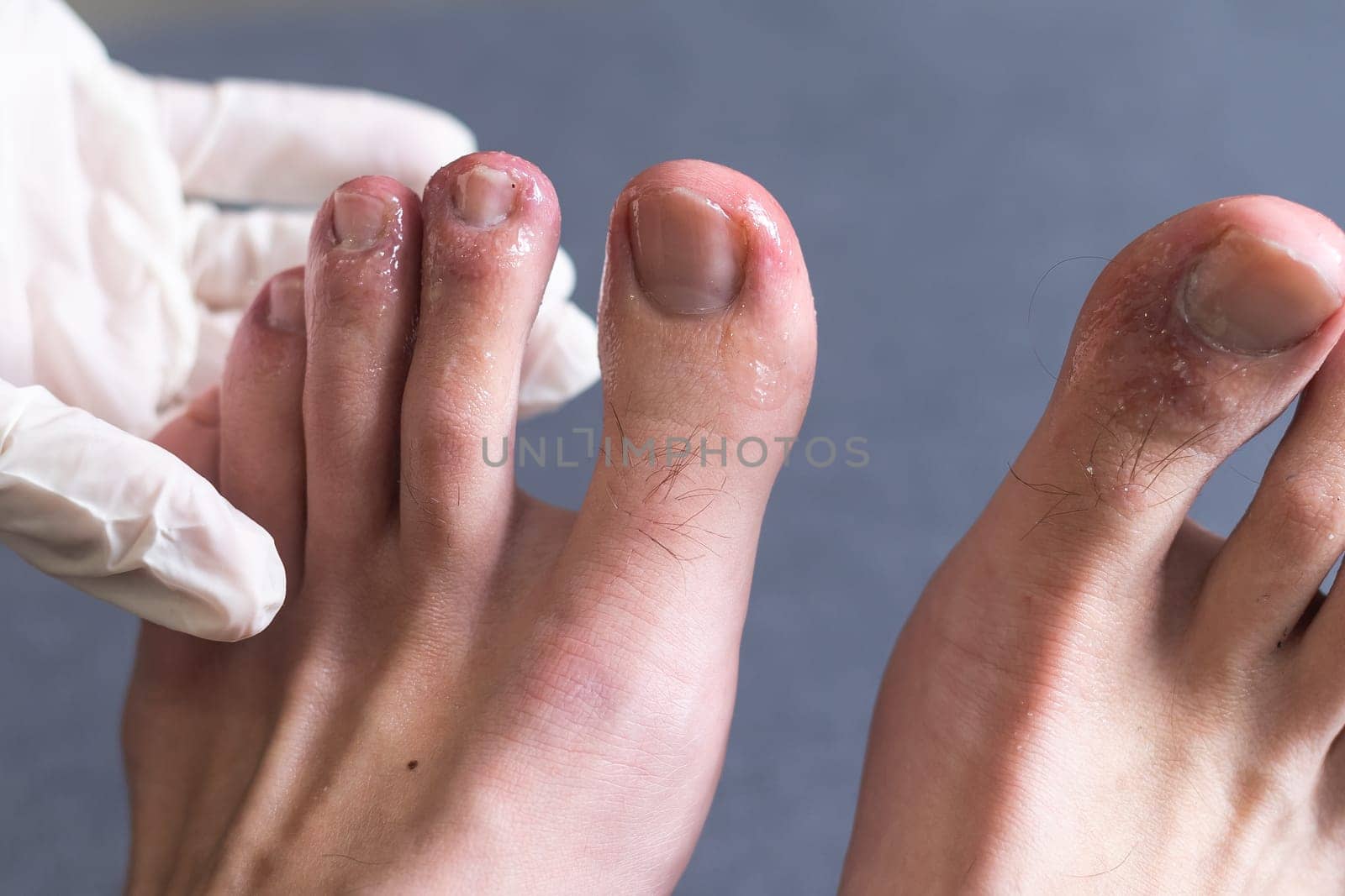A white man holding his toes, showing what looks like a rash with red blotchy skin. A common side effect of Covid-19 often referred to as Covid toe by Andelov13