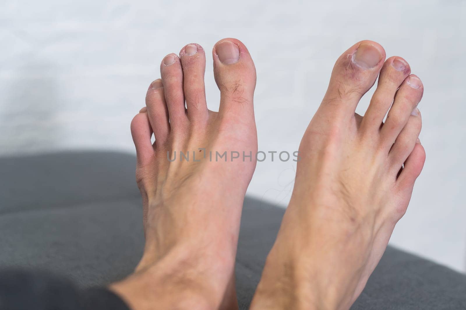 A man's toes showing what looks like a rash with red blotchy skin. A common side effect of Covid-19 often referred to as Covid toe . by Andelov13