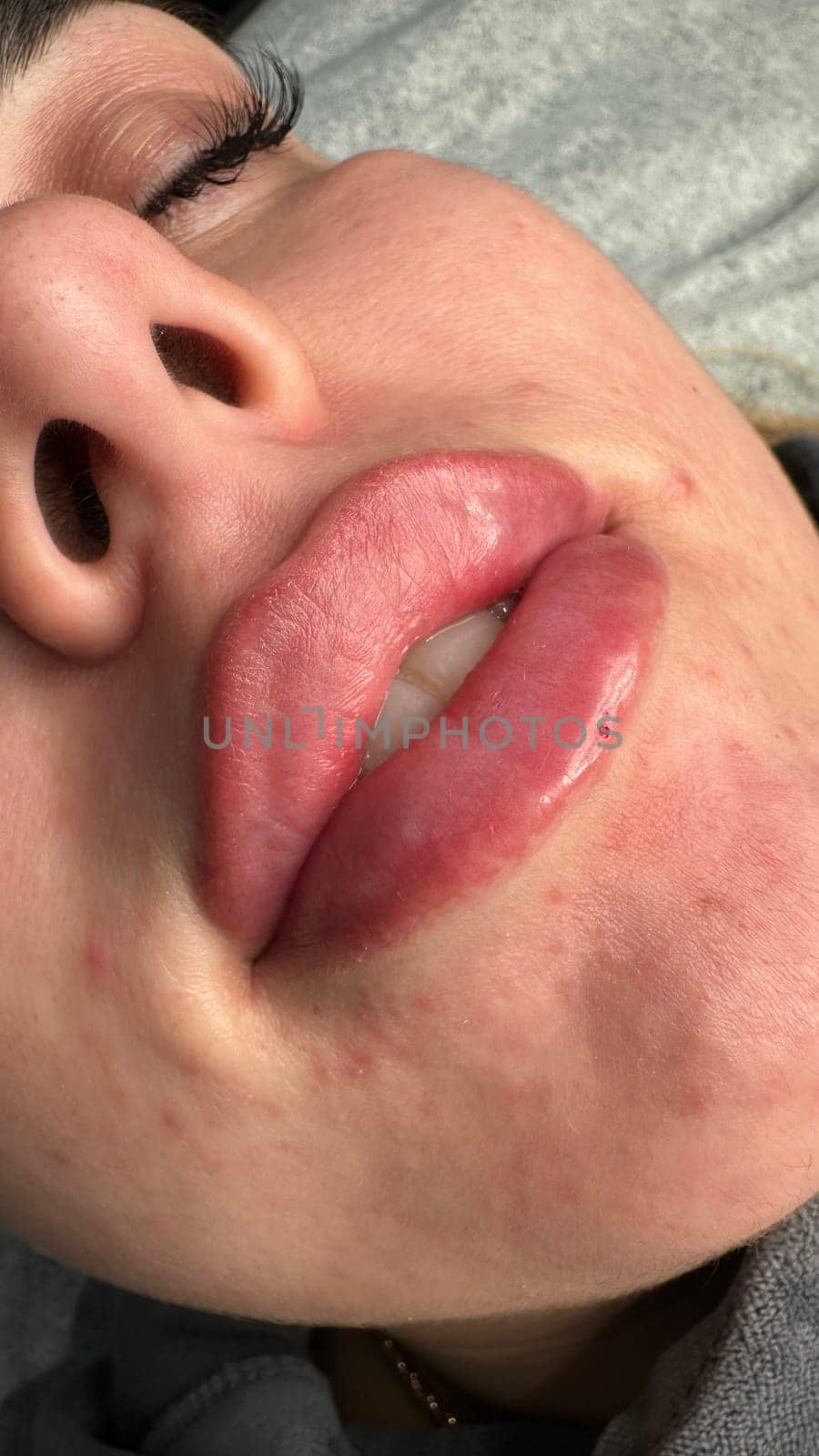 Lush, plump lips. Beautiful shape. After the augmentation procedure