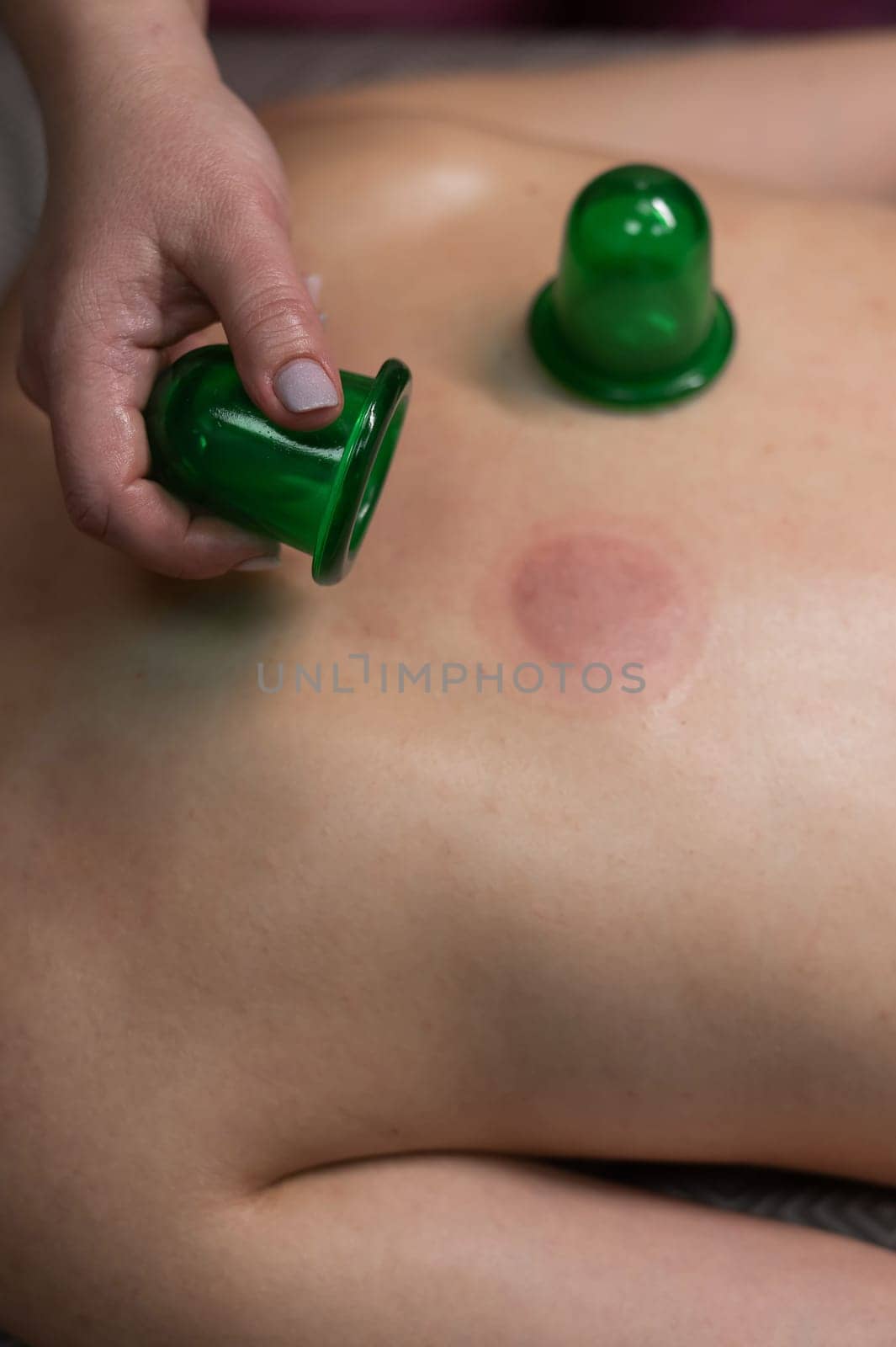 A woman undergoing a massage using vacuum plastic jars. Vertical photo