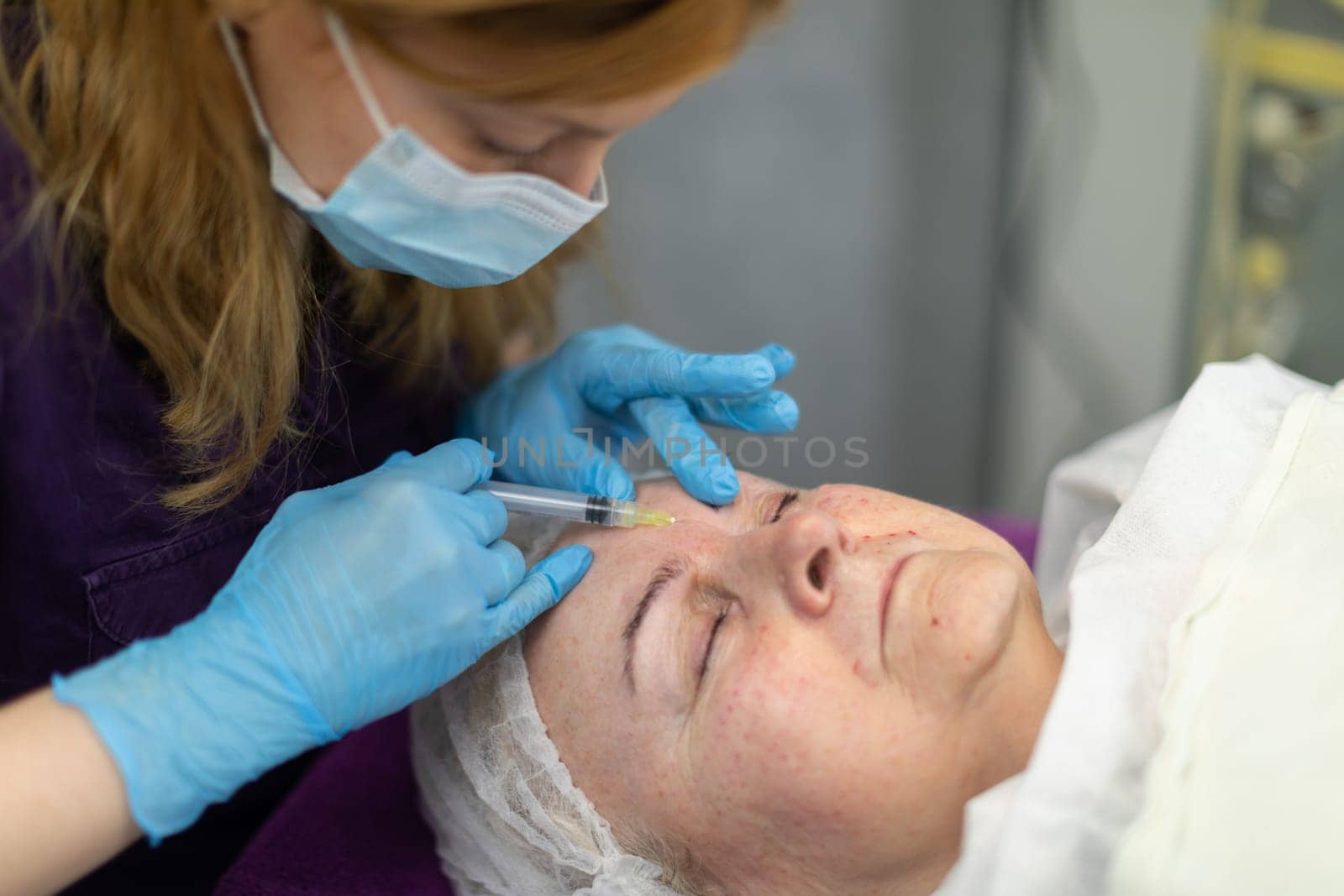 A beauty salon client's face shows fresh punctures. The woman is lying down with her eyes closed and experiencing a needle mesotherapy treatment.