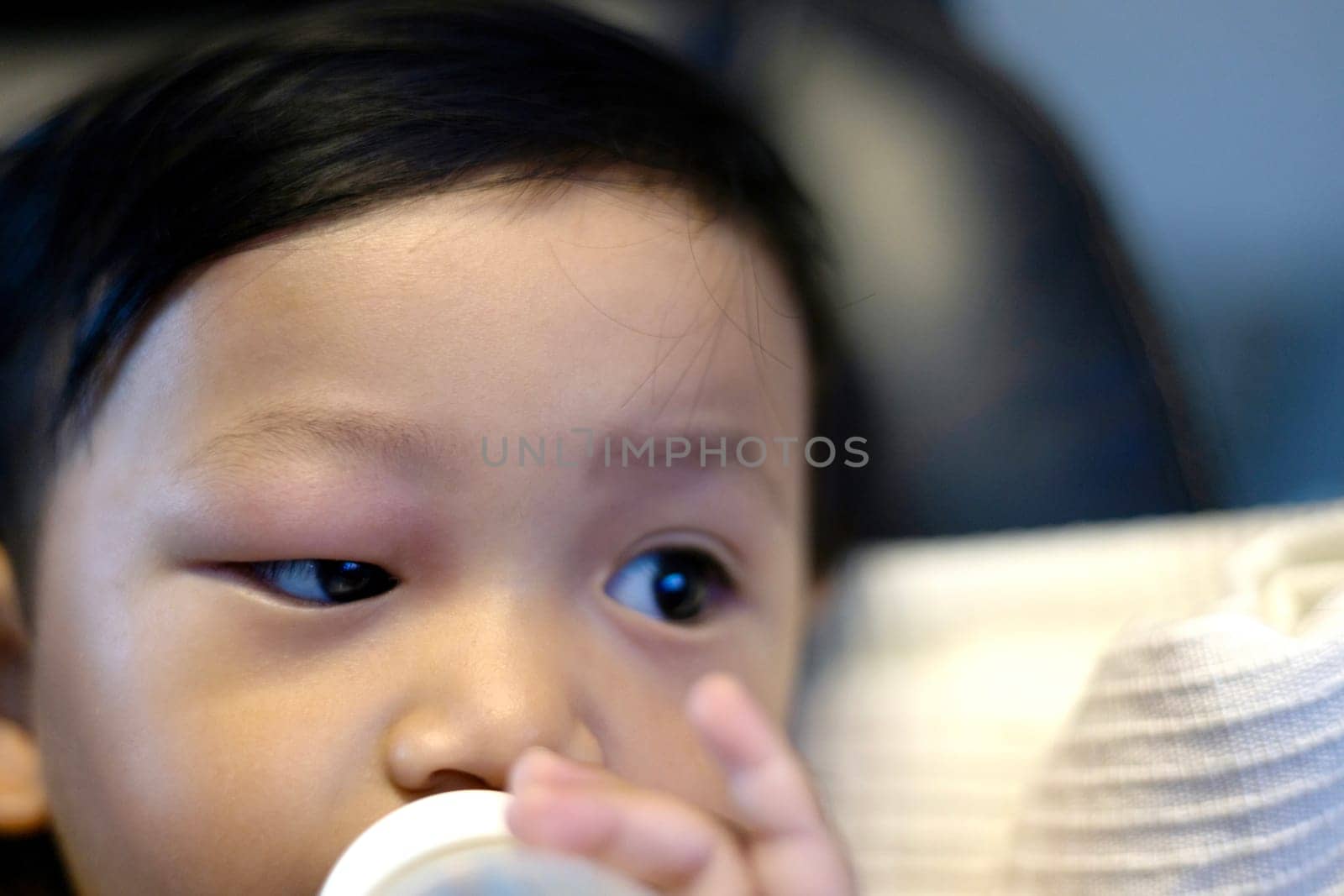 Face Of Boy With A Swollen Eye From An Insect Bite by urzine