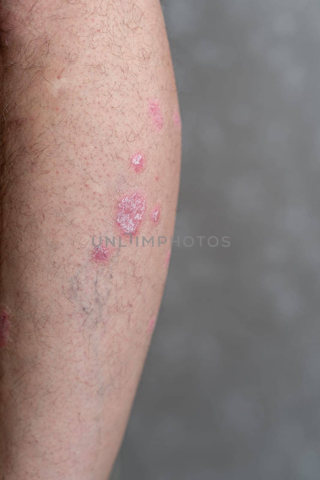 Psoriasis Vulgaris, skin patches are typically red, itchy, and scaly. Papules of chronic psoriasis vulgaris on male hand, back and body. Genetic immune disease. Detail of psoriatic skin disease