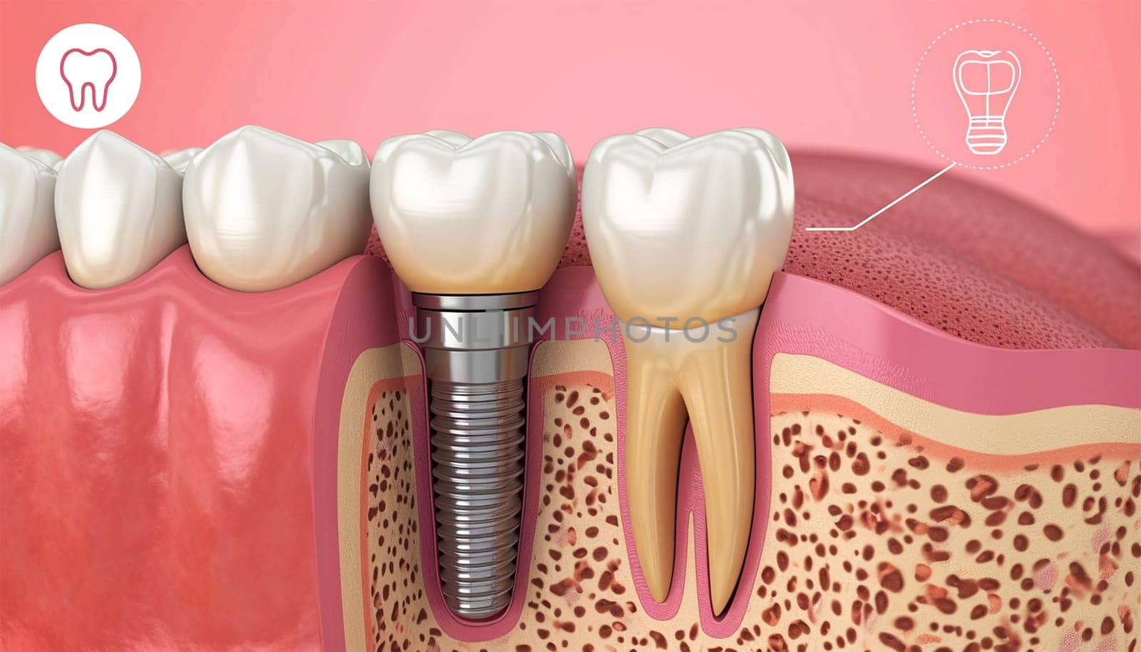 Closeup white tooth and gum with Dental implant , Human Teeth for Medical Concept, 3d illustration. Dental teeth implant healthy teeth and tooth human dentura by Annebel146