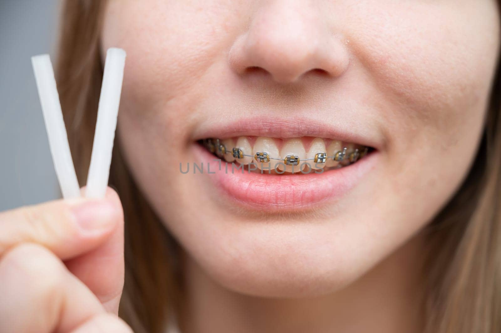 Close-up portrait of a woman with braces using special orthodontic wax