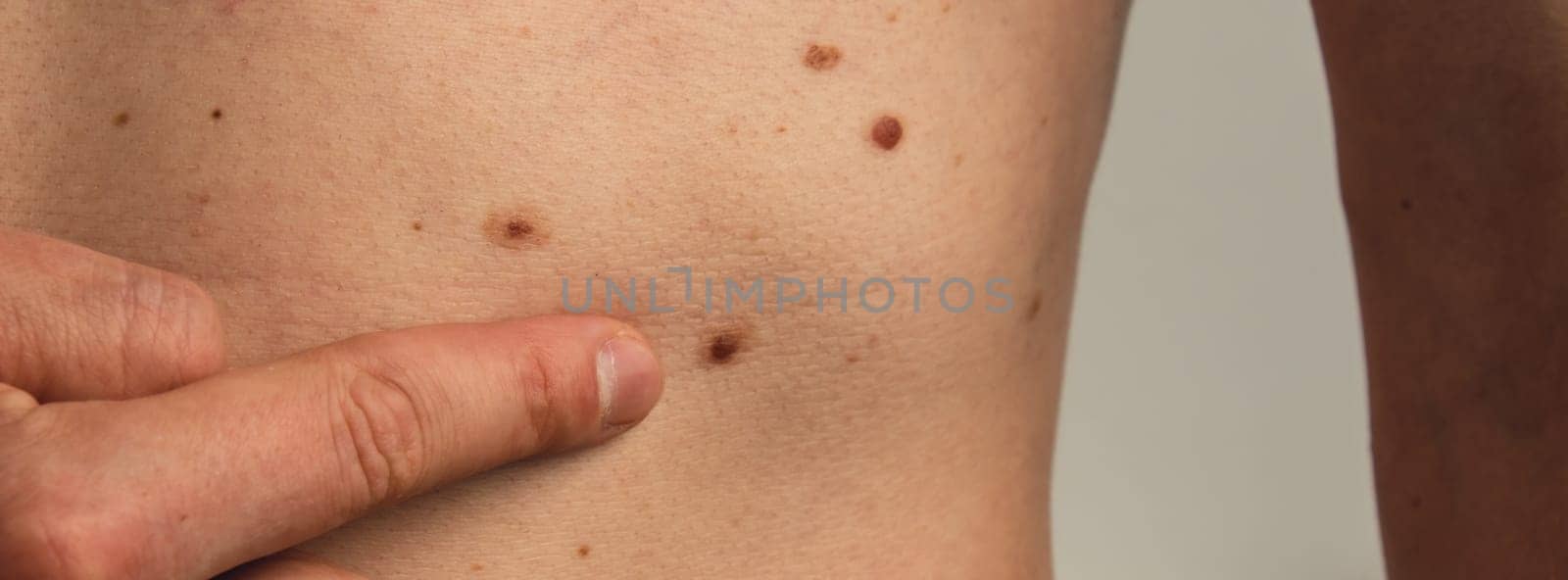 Male hand showing birthmarks on skin body stomach part. Close up detail of the bare skin. Health Effects of UV Radiation. Man with birthmarks Pigmentation by anna_stasiia