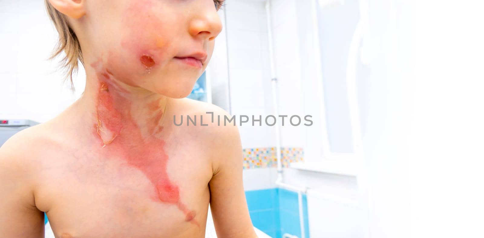 dressing a boy with a burn from boiling water by kajasja