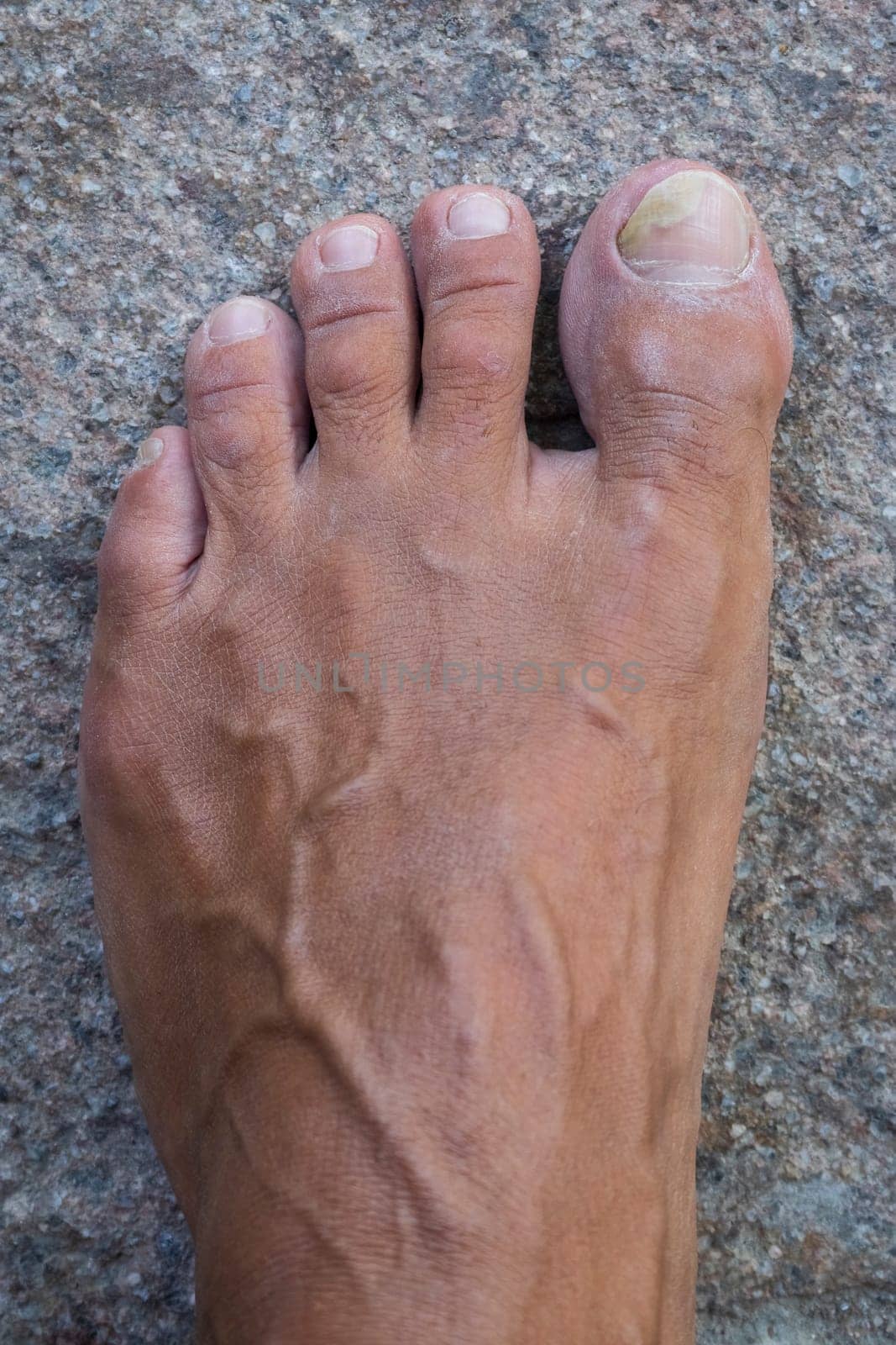Toenails with fungus problems,Onychomycosis, also known as tinea unguium, is a fungal infection of the nail, stone background.