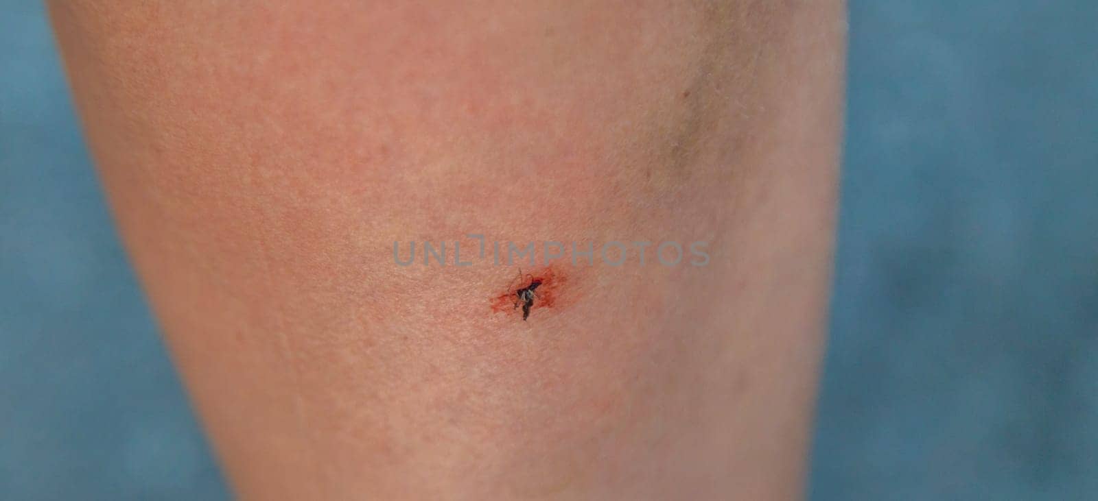 A mosquito bites a person close-up. Selective focus. animal.