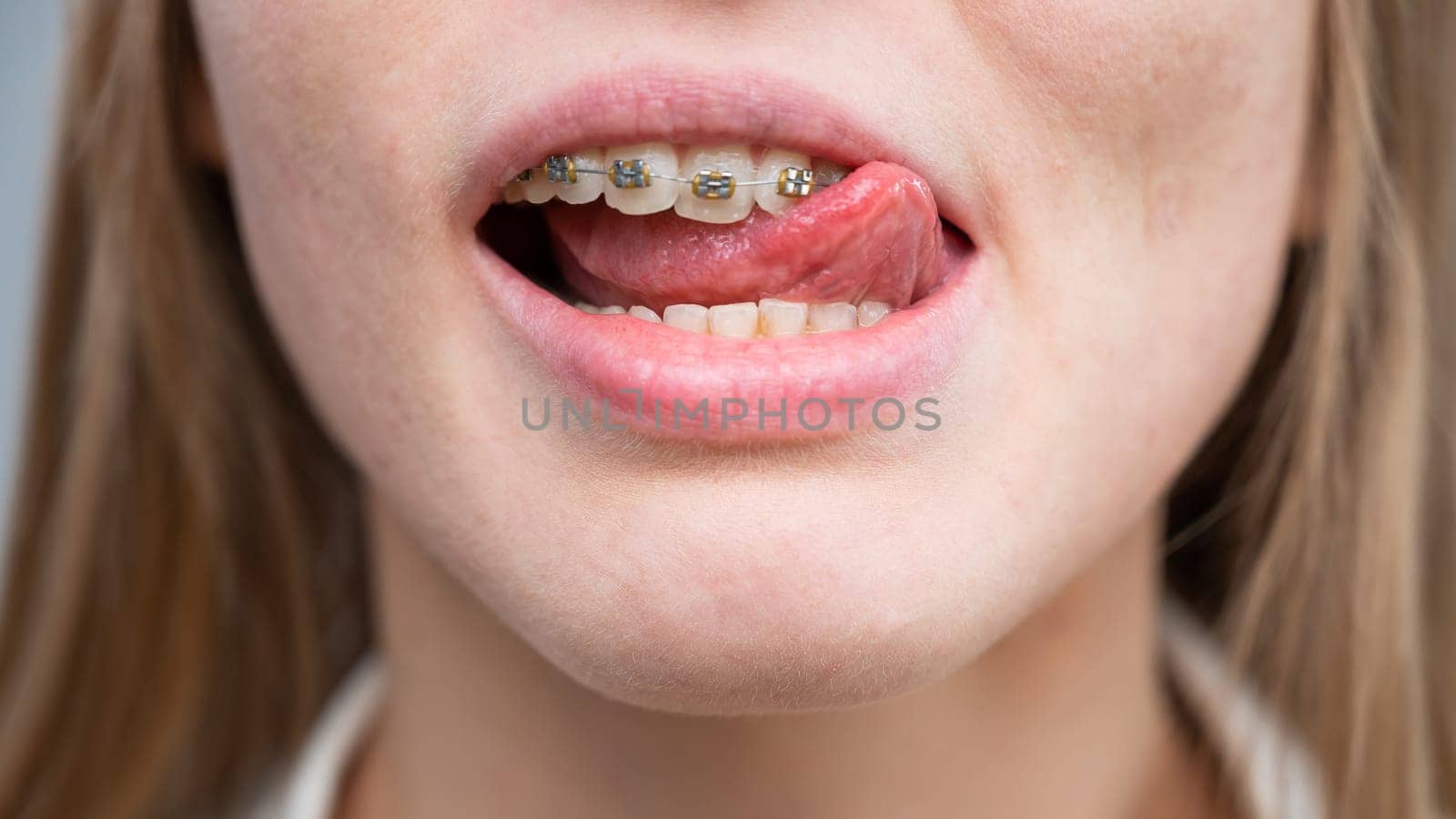 Close-up of a young woman's smile with metal braces on her teeth. Correction of bite by mrwed54