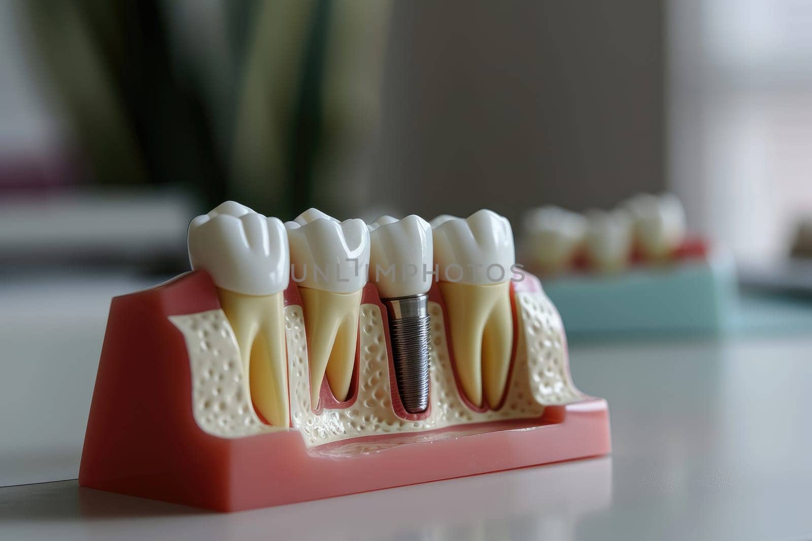 a model structure of teeth with an implant. AI generative by matamnad