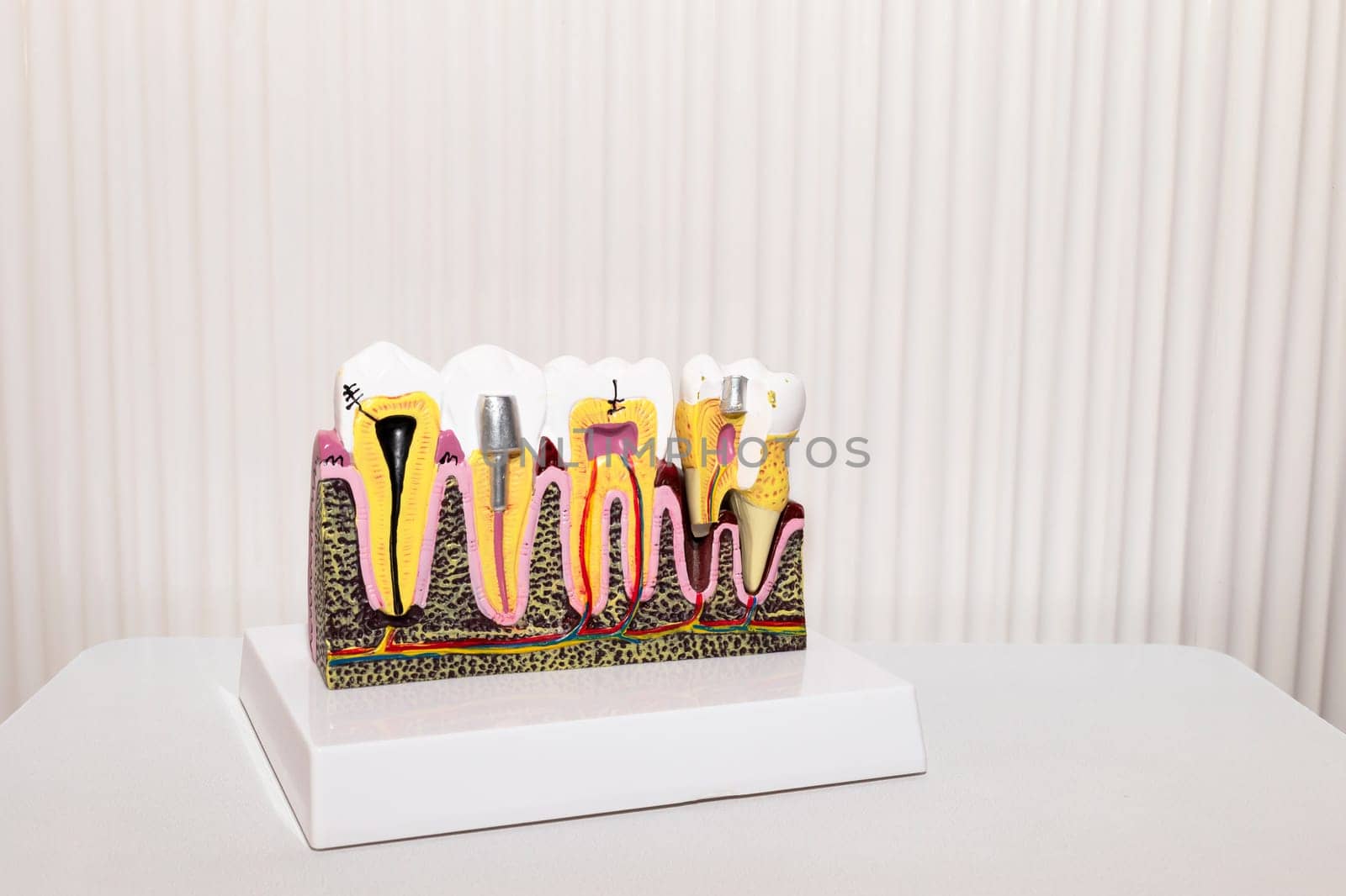 Mockup Dental Tooth Implant, Bridge Or Crown Model On Table, White Background, Copy Space. Dummy Template Human Jaw Oral Dentures. Prosthesis On Metal Peg. Horizontal Plane. High quality photo