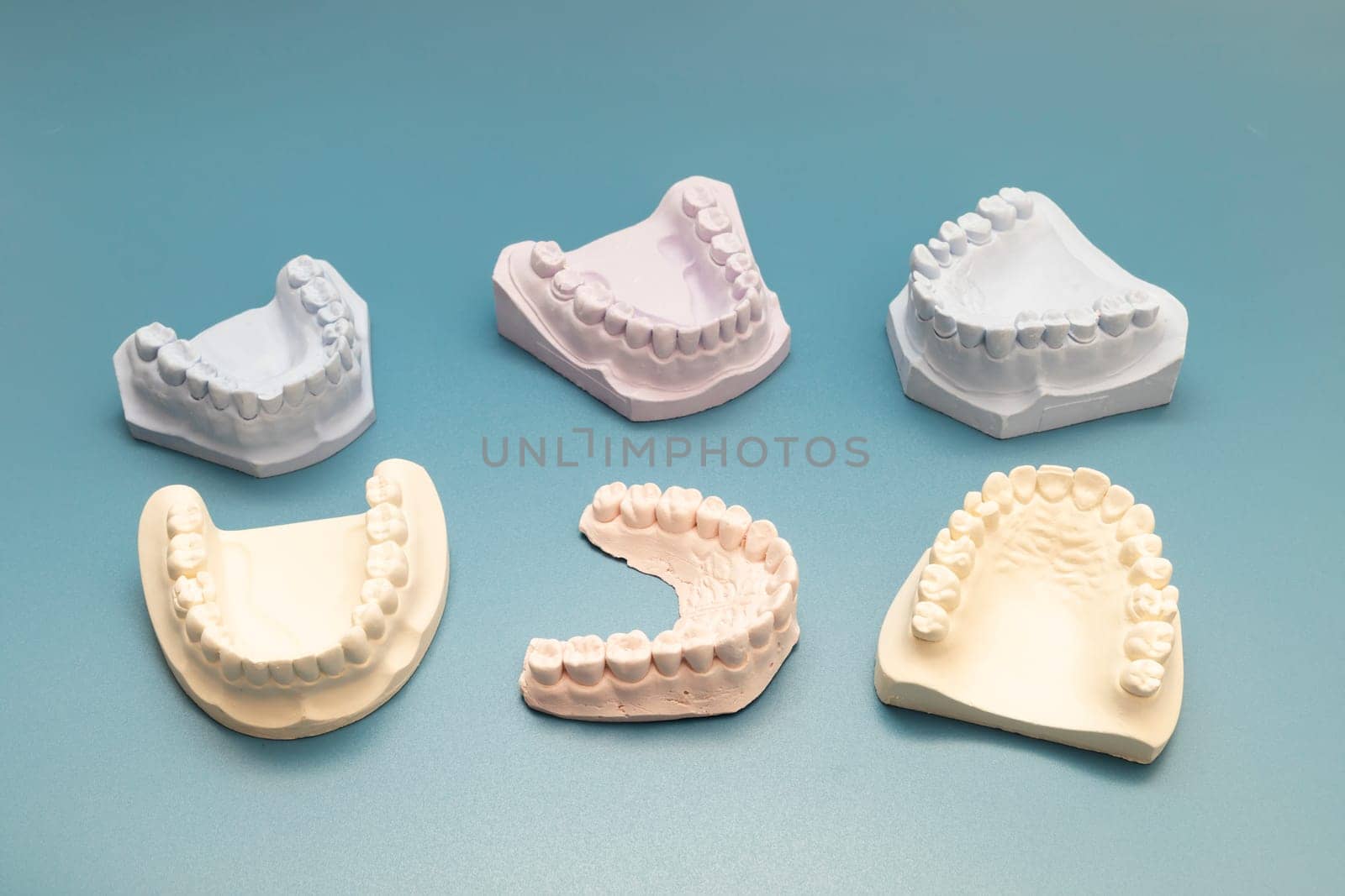Many Die Stone, Plaster Cast Molds Of The Upper And Lower Jaws And Teeth With A Pliable Imprint In Dental Lab On Blue Background. Denture. Dental Gypsum Model, Prosthetics. Horizontal. by netatsi