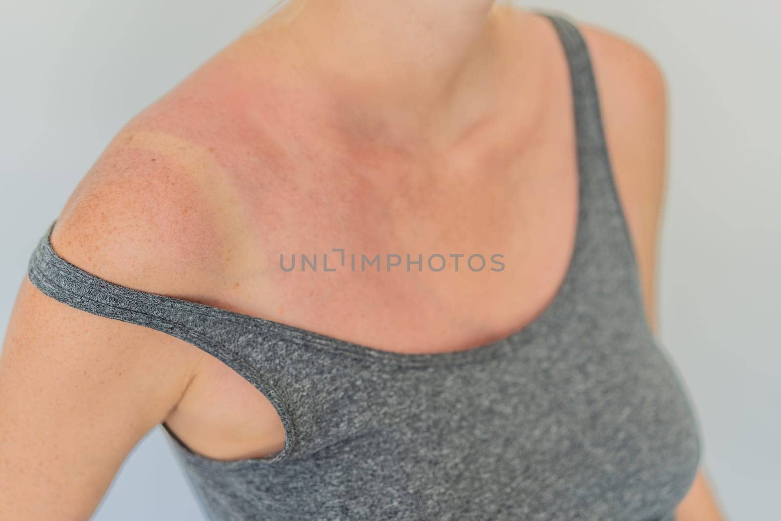 Expectant woman with sunburned, red skin, highlighting the importance of sun protection during pregnancy.