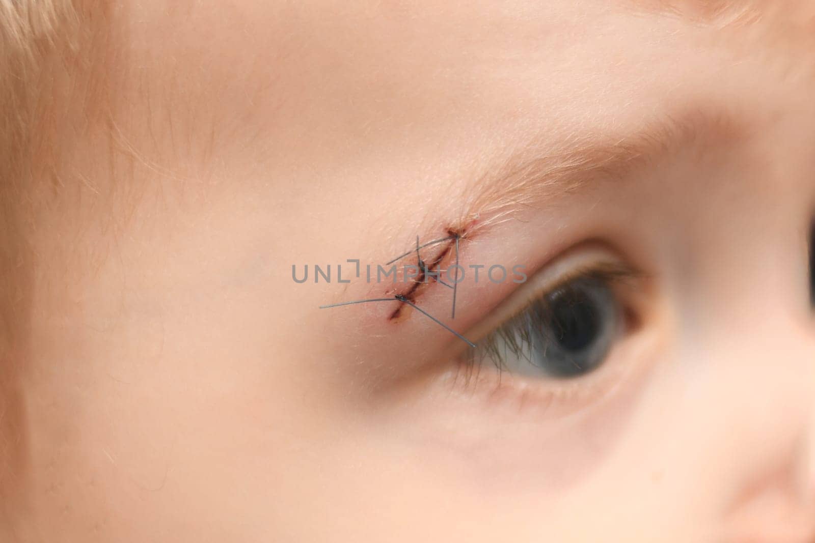 Wound on the eyebrow of a kid after a bruise by Godi