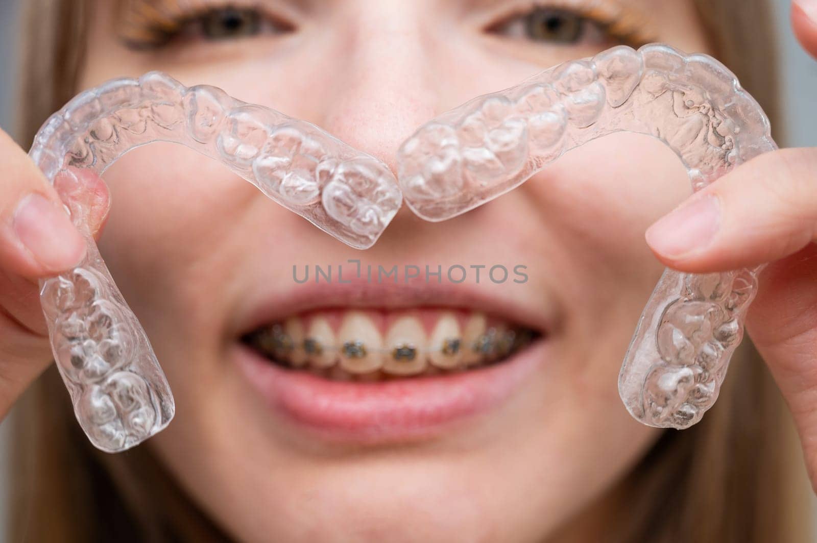 Woman with braces on her teeth holding and removable transparent aligners