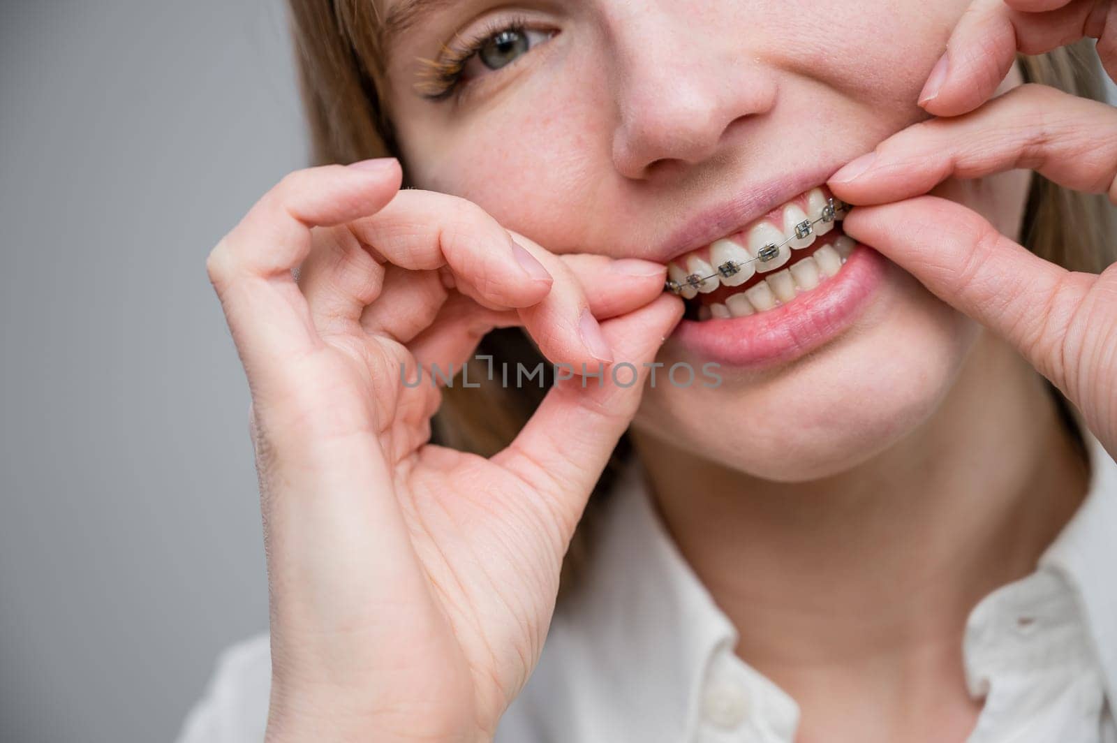 Close-up portrait of a red-haired girl touching braces. Young woman corrects bite with orthodontic appliance