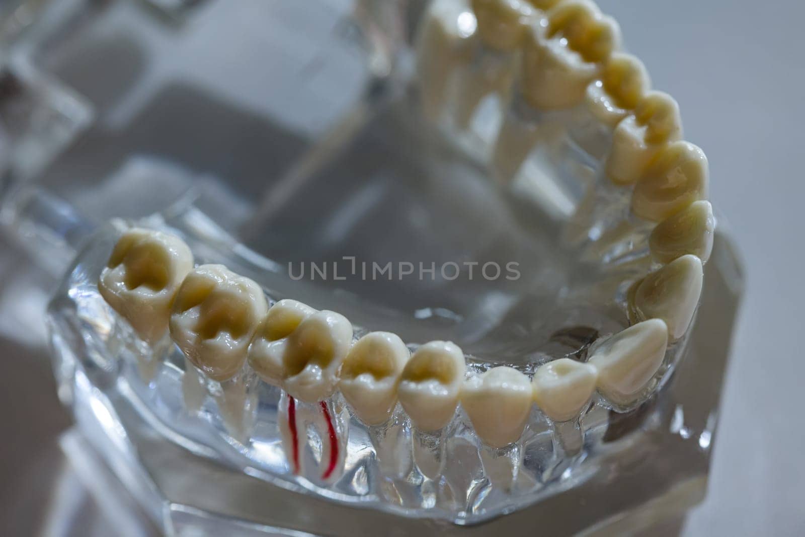 Dental model present common dental disease such as caries, wisdom tooth. Oral health. Copy space. by sarymsakov