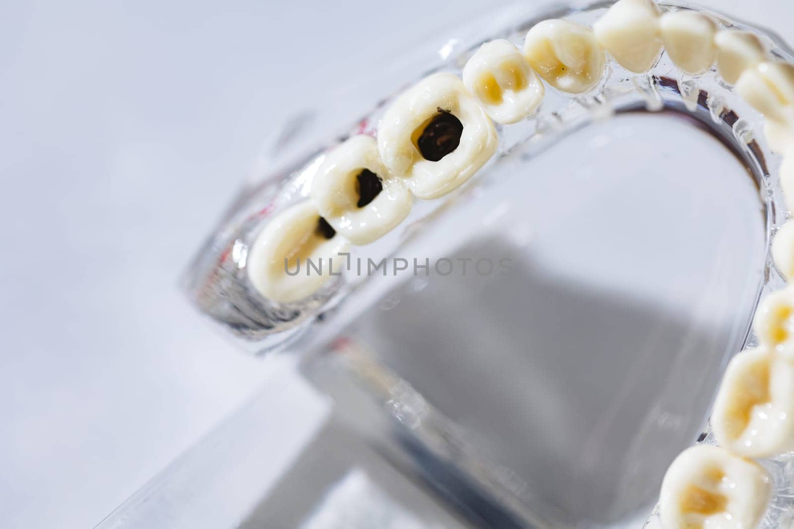 Caries tooth model, oral care concept. Problems with teeth health by sarymsakov