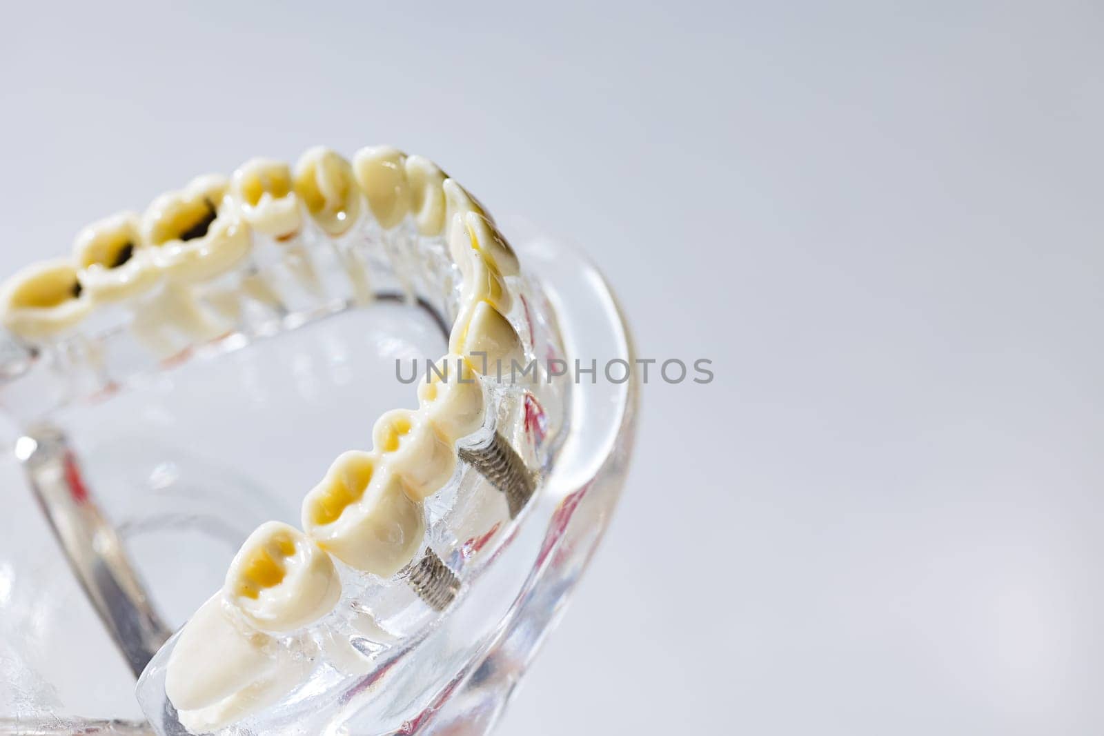Dental model present common dental disease such as caries, wisdom tooth by sarymsakov