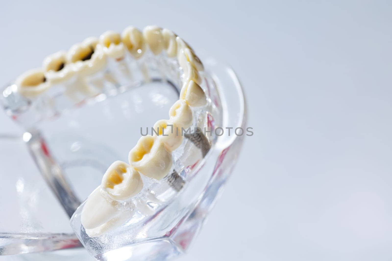 Dental model present common dental disease such as caries, wisdom tooth by sarymsakov