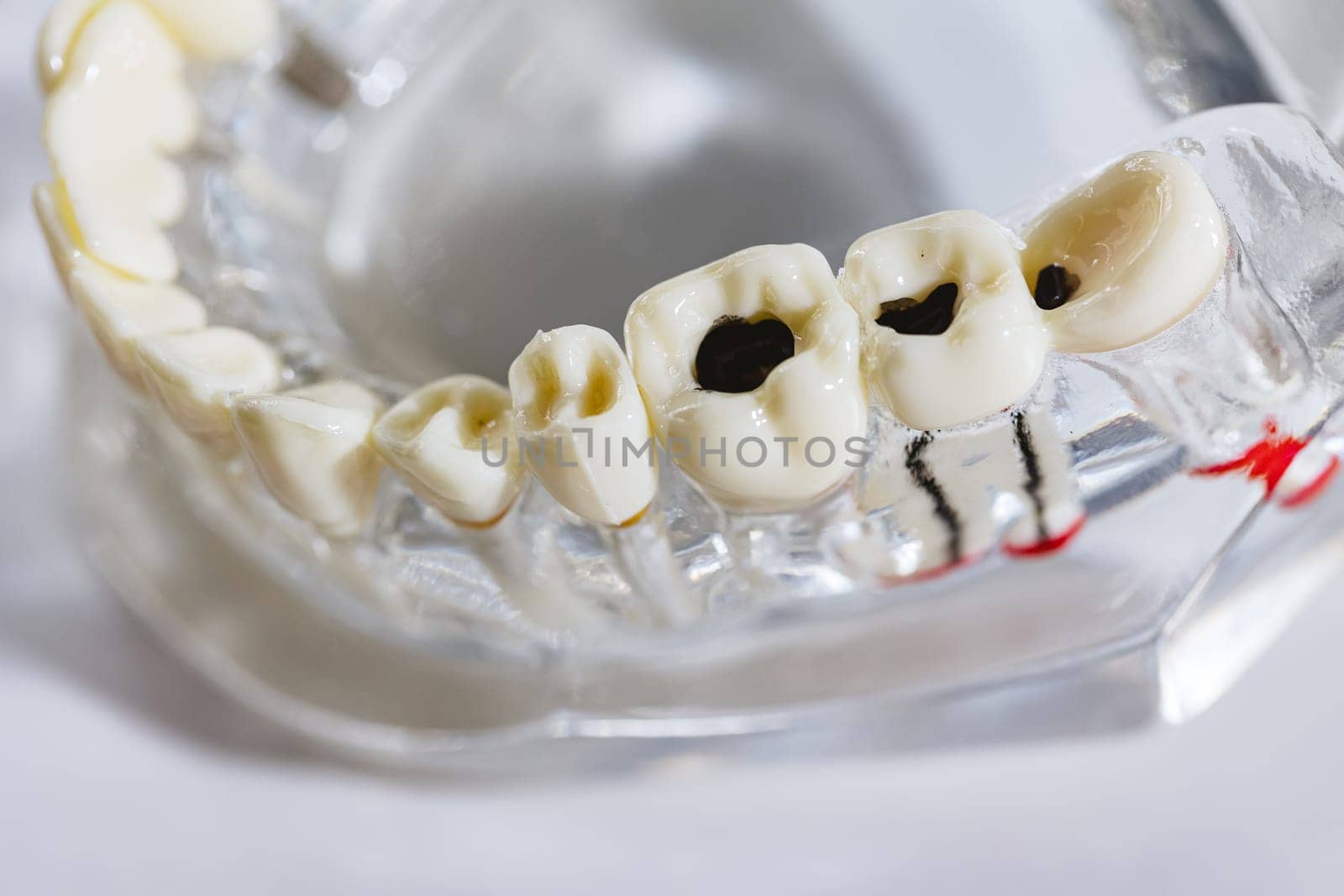 Caries tooth model, oral care concept. Dental model present common dental disease such as caries, wisdom tooth. Oral health. Copy space. Problems with teeth health