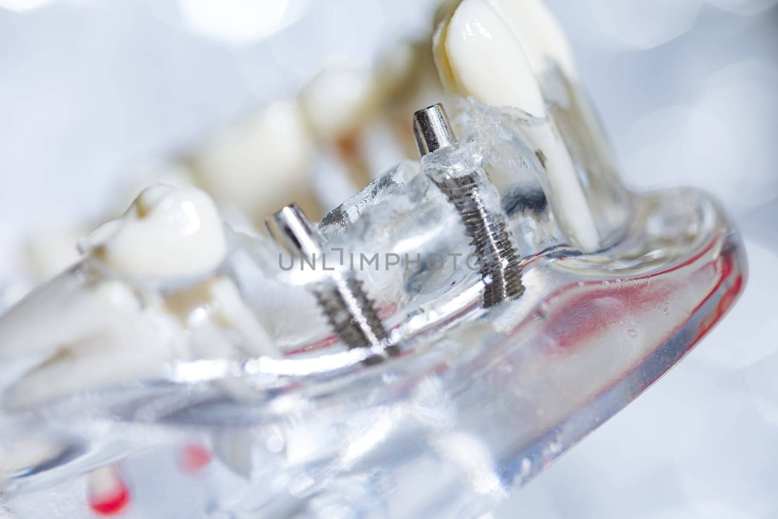 Dental tooth implant titanium prosthetic dentists model. Shallow dof