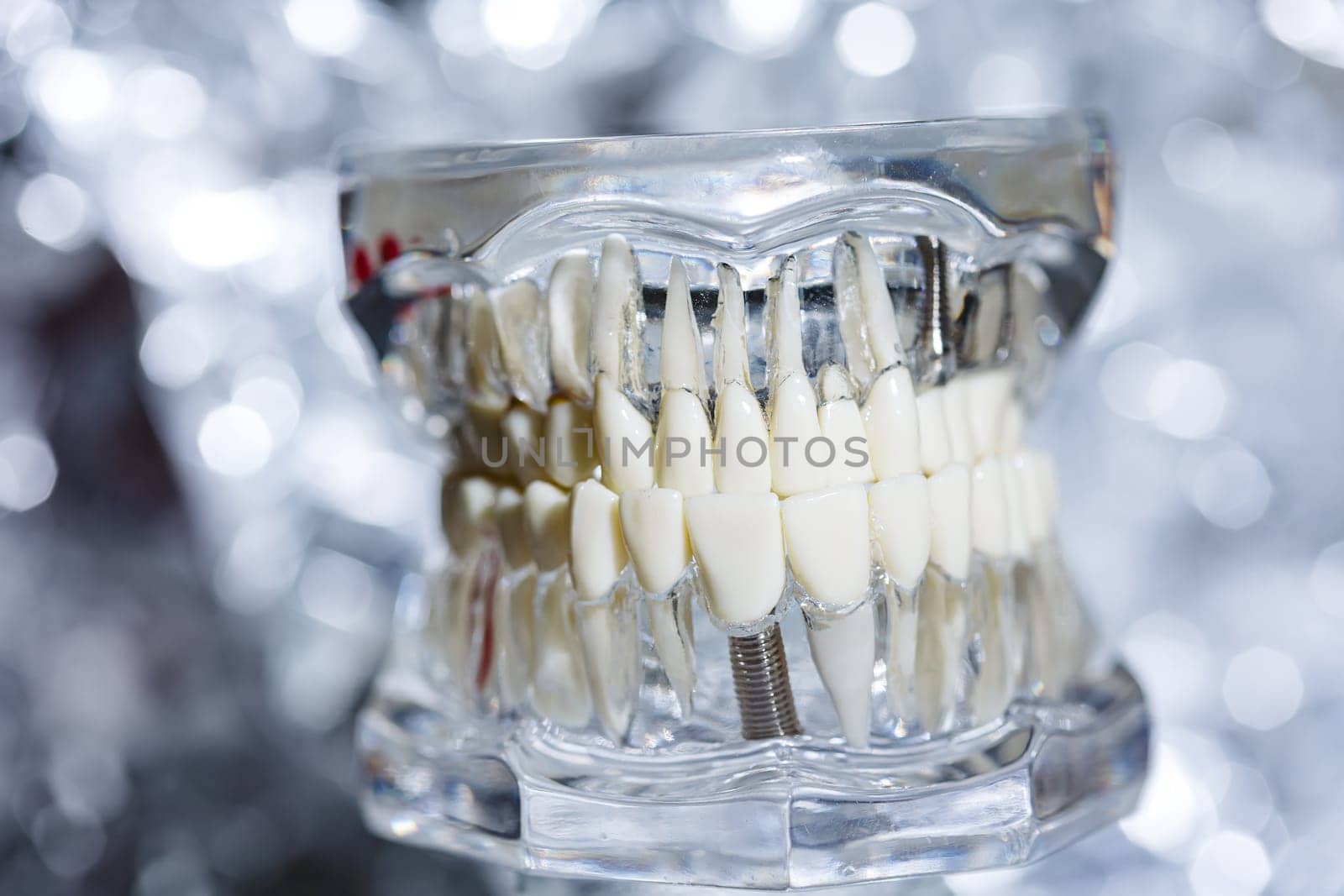 Dental tooth implant titanium prosthetic dentists model. Shallow dof