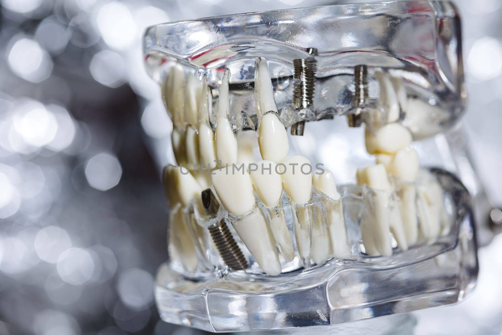 Dental tooth implant titanium prosthetic dentists model. Shallow dof