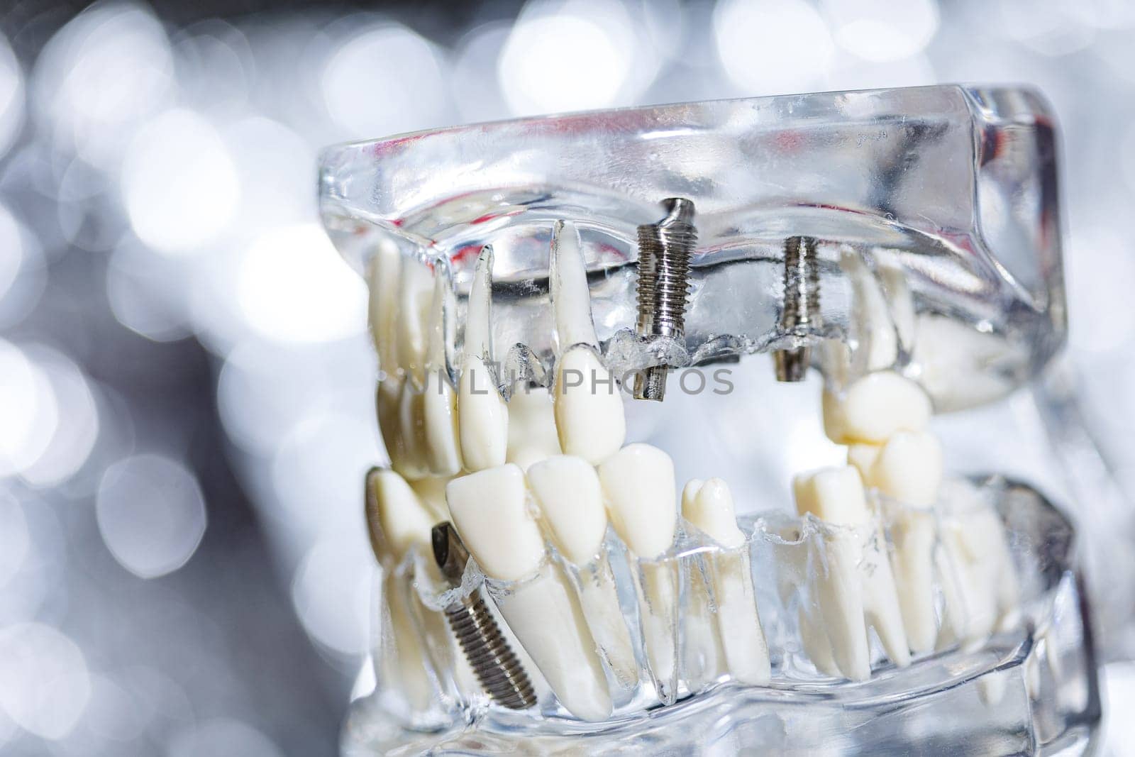 Dental tooth implant titanium prosthetic dentists model. by sarymsakov