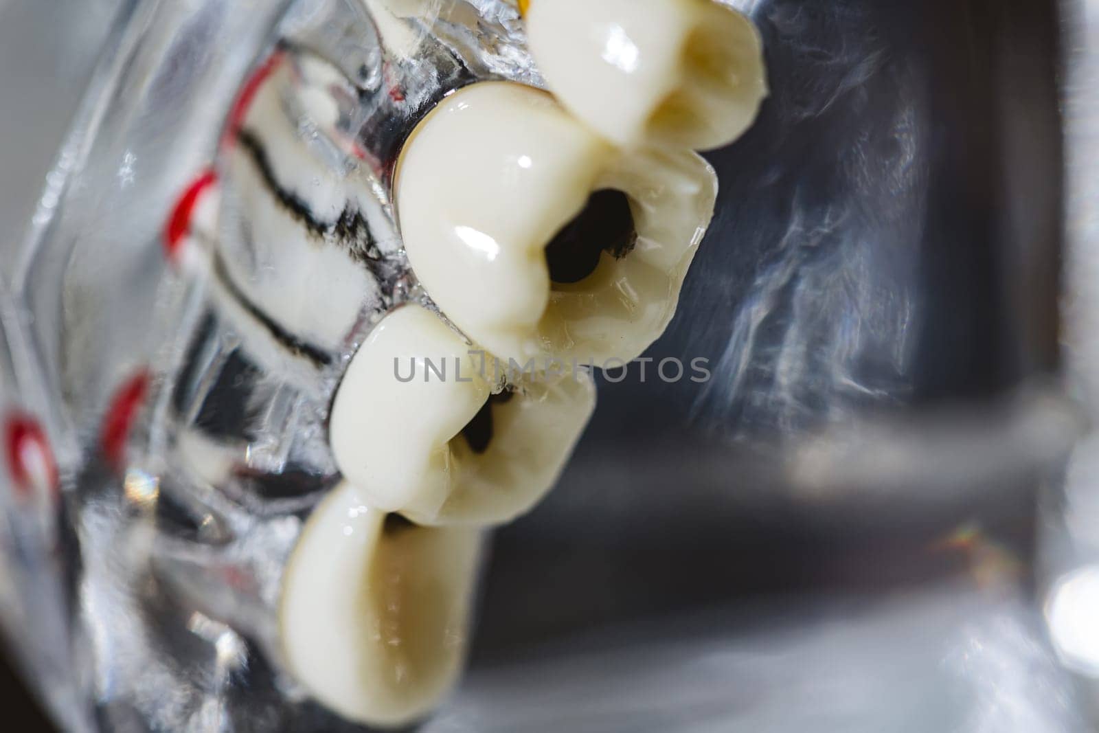 Dental model present common dental disease such as caries, wisdom tooth by sarymsakov