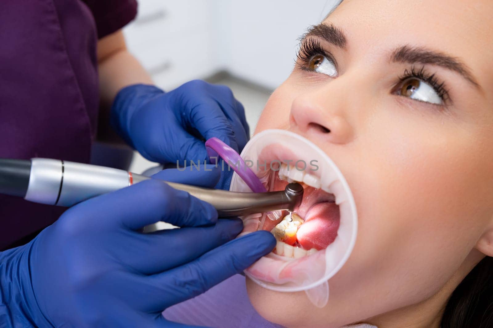 Proficient female dentist in gloves removes damaged part of tooth with dental drill. Cavities treatment process in private dental clinic