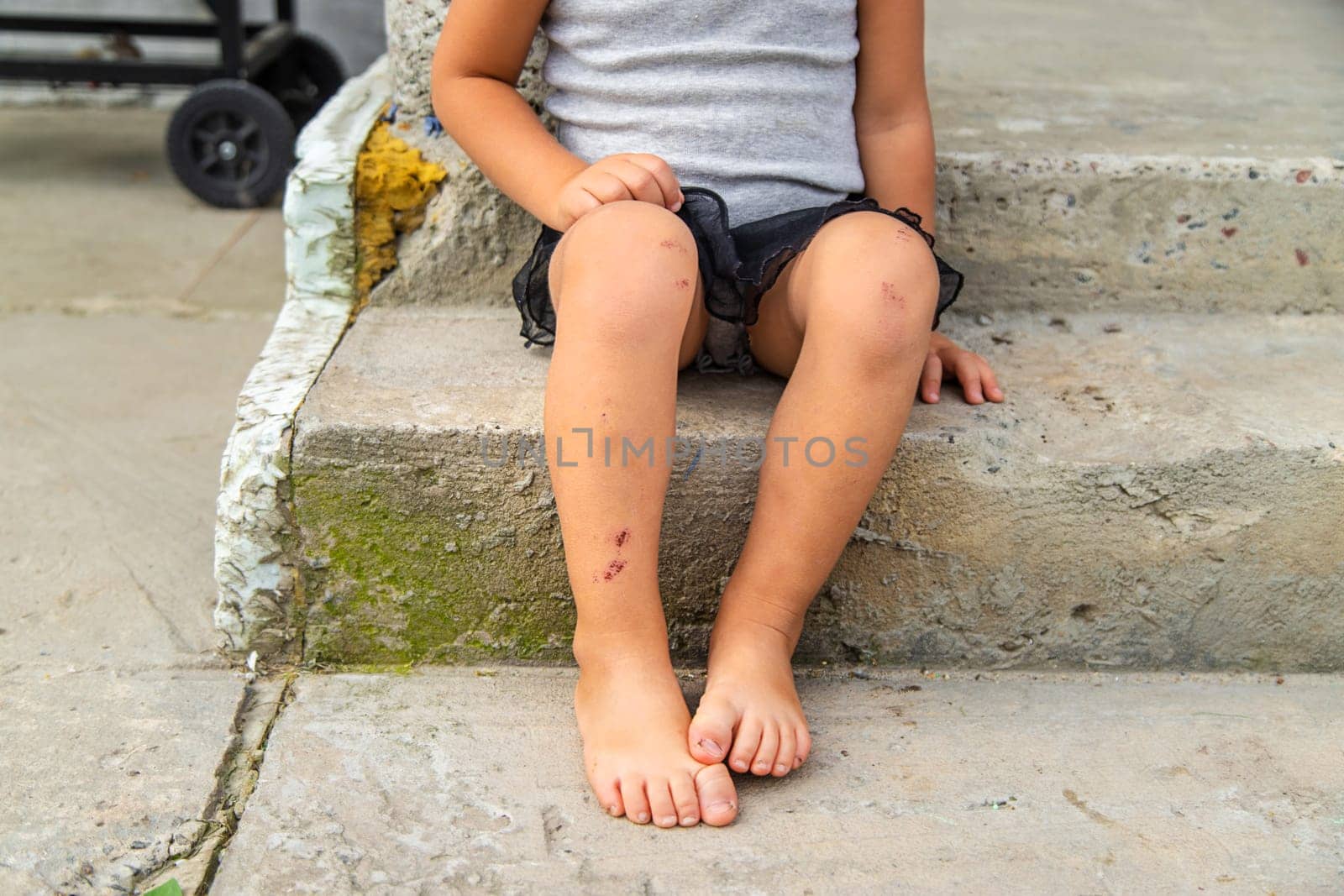 A child has a scratch on his leg. Selective focus. Kid.